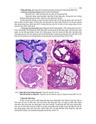 Beänh lyù tuyeán vuù 244
* Taêng saûn oáng: goàm taêng saûn oáng thoâng thöôøng vaø taêng saûn oáng khoâng ñieån hình.
+ Taêng saûn oáng thoâng thöôøng (Usual ductal hyperplasia):
Taêng saûn vöøa: bieåu moâ taêng saûn taïo caàu noái trong loøng oáng
Taêng saûn naëng: loøng oáng giaõn, laáp ñaày teá baøo taêng saûn, nhöng vaãn coøn nhöõng
khoaûng troáng khoâng troøn ñeàu, meùo moù, chen giöõa caùc teá baøo.
Teá baøo taêng saûn khoâng coù hình aûnh baát thöôøng: daân soá teá baøo ña daïng, vaãn coøn lôùp teá
baøo cô bieåu moâ beân ngoaøi. Teá baøo bieåu moâ taêng saûn coù haïch nhaân khoâng roõ, coù khuynh höôùng
xeáp song song nhau, phaân baøo raát ít; tröôøng hôïp taïo caàu noái, teá baøo coù truïc song song vôùi truïc
cuûa caàu noái. (Hình 10 B vaø C)
+ Taêng saûn oáng khoâng ñieån hình (Atypical ductal hyperplasia): Toån thöông giôùi haïn chæ ôû
moät ít oáng tuyeán; toån thöông coù nhieàu ñaëc ñieåm nhöng chöa ñuû ñeå chaån ñoaùn moät carcinoâm oáng
tuyeán vuù taïi choã grad thaáp: teá baøo nhoû, ñoàng daïng, nhaân troøn phaân boá ñeàu ñaën, laáp ñaày loøng
oáng hoaëc taïo caàu noái, taïo saøng coù kích thöôùc ñoàng ñeàu; nhöng trong oáng vaãn coøn moät daân soá teá
baøo thöù hai töông töï nhö nhöõng teá baøo trong taêng saûn oáng thoâng thöôøng. (Hình 10D)
Hình 10:Bieán ñoåi sôïi boïc khoâng taêng sinh: Taêng saûn nheï bieåu moâ (A);
Bieán ñoåi sôïi boïc coù taêng sinh: Taêng saûn vöøa (B),Taêng saûn naëng (C),Taêng saûn khoâng ñieån hình (D).
* Taêng saûn tieåu thuøy:
ÔÛ ñaây, chuùng ta chæ noùi ñeán taêng saûn tieåu thuøy khoâng ñieån hình. Ñaây laø moät thöïc theå coù
hình thaùi moâ hoïc vaø dieãn tieán sinh hoïc khaùc haún taêng saûn oáng, vôùi nguy cô dieãn tieán thaønh
carcinoâm tieåu thuøy xaâm laán taêng gaáp 5 laàn bình thöôøng. Trong taêng saûn tieåu thuøy khoâng ñieån
hình chæ coù döôùi 50% oáng taän (hoaëc tuùi tuyeán) trong tieåu thuøy bò giaõn roäng, laáp ñaày bôûi caùc teá
baøo ñoàng daïng, nhaân troøn nhaït maøu, haïch nhaân nhoû. Teá baøo keát dính nhau loûng leûo, saép xeáp
khoâng ñònh höôùng, coøn khoaûng troáng giöõa caùc teá baøo. (Hình 11)
C D
 