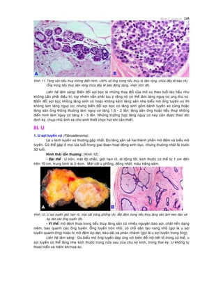 Beänh lyù tuyeán vuù 245
Hình 11: Taêng saûn tieåu thuøy khoâng ñieån hình: <50% soá oáng trong tieåu thuøy bò daõn roäng, chöùa ñaày teá baøo (A);
OÁng trong tieåu thuyø daõn roäng chöùa ñaày teá baøo ñoàng daïng, nhaân troøn (B).
Lieân heä laâm saøng: Bieán ñoåi sôïi boïc laø nhöõng thay ñoåi cuûa moâ vuù theo tuoåi taùc haàu nhö
khoâng caàn phaûi ñieàu trò; tuy nhieân vaãn phaûi löu yù raèng noù coù theå laøm taêng nguy cô ung thö vuù.
Bieán ñoåi sôïi boïc khoâng taêng sinh coù hoaëc khoâng keøm taêng saûn nheï bieåu moâ oáng tuyeán vuù thì
khoâng laøm taêng nguy cô; nhöng bieán ñoåi sôïi boïc coù taêng sinh goàm beänh tuyeán xô cöùng hoaëc
taêng saûn oáng thoâng thöôøng laøm nguy cô taêng 1,5 - 2 laàn; taêng saûn oáng hoaëc tieåu thuyø khoâng
ñieån hình laøm nguy cô taêng 4 - 5 laàn. Nhöõng tröôøng hôïp taêng nguy cô naøy caàn ñöôïc theo doõi
ñònh kyø, chuïp nhuõ aûnh vaø cho sinh thieát choïc huùt khi caàn thieát.
III. U
1. U sôïi tuyeán vuù (Fibroadenoma):
Laø u laønh tuyeán vuù thöôøng gaëp nhaát. Do taêng saûn caû hai thaønh phaàn moâ ñeäm vaø bieåu moâ
tuyeán. Coù theå gaëp ôû moïi löùa tuoåi trong giai ñoaïn hoaït ñoäng sinh duïc, nhöng thöôøng nhaát laø tröôùc
30 tuoåi.
Hình thaùi toån thöông: (Hình 12)
- Ñaïi theå : U troøn, maät ñoä chaéc, giôùi haïn roõ, di ñoäng toát, kích thöôùc coù theå töø 1 cm ñeán
treân 10 cm, trung bình laø 2-4cm. Maët caét u phoàng, ñoàng nhaát, maøu traéng xaùm.
Hình 12: U sôïi tuyeán giôùi haïn roõ, maët caét traéng phoàng (A); Moâ ñeäm trong tieåu thuøy taêng saûn laøm keùo daõn vaø
eùp deït caùc oáng tuyeán (B).
- Vi theå: moâ ñeäm thöa trong tieåu thuøy taêng saûn coù nhieàu nguyeân baøo sôïi, chaát neàn daïng
nieâm, bao quanh caùc oáng tuyeán. OÁng tuyeán troøn nhoû, coù choã daõn taïo nang nhoû (goïi laø u sôïi
tuyeán quanh oáng) hoaëc bò moâ ñeäm eùp deït, keùo daøi vaø phaân nhaùnh (goïi laø u sôïi tuyeán trong oáng).
Lieân heä laâm saøng : Do bieåu moâ oáng tuyeán ñaùp öùng vôùi bieán ñoåi noäi tieát toá trong cô theå, u
sôïi tuyeán coù theå taêng nheï kích thöôùc trong nöûa sau cuûa chu kyø kinh, trong thai kyø. U khoâng töï
thoaùi trieån vaø hieám khi hoaù aùc.
 
