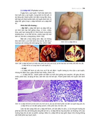 Beänh lyù tuyeán vuù 246
2. U dieäp theå (Phyllodes tumor):
Ít gaëp hôn u sôïi tuyeán. Tuoåi maéc beänh lôùn
hôn tuoåi cuûa u sôïi tuyeán, trung bình laø 50 tuoåi. U
do taêng saûn thaønh phaàn moâ ñeäm trong tieåu thuøy,
keát hôïp vôùi thaønh phaàn bieåu moâ tuyeán laønh tính. U
dieäp theå goàm 2 loaïi: u dieäp theå laønh vaø u dieäp theå
aùc.
Hình thaùi toån thöông :
- Ñaïi theå: u dieäp theå laønh vaø dieäp theå aùc
coù hình aûnh ñaïi theå gioáng nhau. U troøn, nhieàu
thuøy, giôùi haïn töông ñoái roõ. Kích thöôùc trung bình
khoaûng 5cm. U coù theå raát lôùn, chieám toaøn boä moät
beân vuù, da treân u caêng boùng. (Hình 13A)
Maët caét u maøu traéng xaùm, ñaëc, coù nhöõng
khe raõnh laøm u coù hình aûnh nhö caùi laù; ñoâi khi u
hoaù boïc vôùi nhöõng noát choài daïng nhuù. (Hình 13B)
Hình 13 A: U dieäp theå vuù
Hình 13B: U dieäp theå laønh coù nhieàu khe raõnh nhö hình caùi laù (A); coù khi hoaù boïc vôùi nhieàu noát choài nhuù (B);
U dieäp theå aùc coù vuøng hoaïi töû xuaát huyeát (C).
- Vi theå:
+ U dieäp theå laønh coù caáu truùc vaø tæ leä moâ ñeäm / tuyeán töông töï nhö cuûa u sôïi tuyeán,
nhöng moâ ñeäm cuûa u giaøu teá baøo hôn nhieàu. (Hình 14)
+ U dieäp theå aùc : thaønh phaàn moâ ñeäm coù hình aûnh gioáng nhö sarcoâm, raát giaøu teá baøo,
nhieàu phaân baøo, dò daïng teá baøo, xaâm laán vaøo moâ keá caän. Thaønh phaàn bieåu moâ tuyeán vaãn laønh
tính.
Hình 14: U dieäp theå laønh coù khe raõnh nhö hình caùi laù, caáu taïo bôûi thaønh phaàn moâ ñeäm vaø tuyeán taêng saûn (A);
U dieäp theå aùc coù moâ ñeäm gioáng sarcoâm, nhieàu phaân baøo (muõi teân), (B).
Lieân heä laâm saøng: Ñoái vôùi u dieäp theå laønh, chæ caàn ñieàu trò caét u. U coù khuynh höôùng taùi
phaùt taïi choã neáu caét khoâng ñuû roäng ñeå soùt moâ u. U dieäp theå aùc hay taùi phaùt, vaø khoaûng 12% caùc
tröôøng hôïp cho di caên xa (phoåi, xöông). Ñieàu trò u dieäp theå aùc bao goàm ñoaïïn nhuõ nhöng khoâng
caàn thieát phaûi naïo haïch naùch.
 