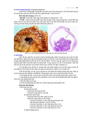 Beänh lyù tuyeán vuù 247
3. U nhuù trong oáng söõa (Intraductal papilloma):
U laønh tính, thöôøng gaëp ôû oáng daãn söõa chính hay trong xoang söõa. Tuoåi maéc beänh laø phuï
nöõ trung nieân hoaëc lôùn tuoåi hôn. Ñoâi khi u gaây tieát dòch - maùu nuùm vuù.
Hình thaùi toån thöông: (Hình 15)
- Ñaïi theå: U ñôn ñoäc, naèm ngay döôùi quaàng vuù, ñöôøng kính < 1cm.
- Vi theå: U naèm trong oáng daãn söõa chính bò giaõn hoaëc trong xoang söõa. U phaùt trieån taïo
nhieàu nhuù coù truïc lieân keát maïch maùu, phuû beân treân laø hai lôùp teá baøo bieåu moâ vaø cô bieåu moâ.
Thöôøng coù hieän töôïng chuyeån saûn ñænh tieát teá baøo bieåu moâ.
Hình 15: U nhuù trong oáng söõa (A); U taïo choài nhuù nhoâ vaøo loøng oáng (B).
4. Carcinoâm
Dòch teã hoïc: Ung thö vuù laø loaïi ung thö thöôøng gaëp nhaát ôû nöõ giôùi taïi caùc nöôùc AÂu Myõ.
Taïi Vieät Nam, ñaây laø loaïi ung thö ñöùng ñaàu ôû giôùi nöõ cuûa caû 2 mieàn Nam Baéc theo soá lieäu thoáng
keâ gaàn ñaây (2004-08) cuûa Haø noäi vaø TP. Hoà Chí Minh. Tæ leä töû vong do ung thö vuù chæ ñöùng sau
ung thö phoåi. Ñænh tuoåi maéc beänh laø 40-60 tuoåi. Trong ung thö vuù, 99 % laø carcinoâm, moät tæ leä
nhoû coøn laïi laø caùc sarcoâm nhö sarcoâm maïch maùu, sarcoâm moâ ñeäm, limphoâm vuù, ….
Cô cheá beänh sinh: khoâng roõ, nhöng hieän nay nhieàu nghieân cöùu veà laâm saøng vaø dòch teã
cho thaáy coù moät soá yeáu toá lieân quan vôùi nguy cô maéc beänh ung thö vuù ôû nöõ giôùi nhö:
+Yeáu toá gia ñình: coù meï, chò bò ung thö vuù. Khi khaûo saùt nhöõng tröôøng hôïp naøy, thaáy coù
söï löu haønh caùc gen BRCA1 vaø BRCA2; nhöõng beänh nhaân naøy coù tuoåi maéc beänh treû hôn.
+ Tình traïng noäi tieát : coù kinh sôùm, maõn kinh muoän, coù con ñaàu loøng muoän, sanh ít con.
+ Taùc ñoäng cuûa moâi tröôøng: taàn suaát beänh ôû caùc nöôùc coâng nghieäp phaùt trieån cao gaáp 4-
5 laàn caùc nöôùc ñang phaùt trieån.
+ Tieàn caên tieáp xuùc tia xaï;
+ Coù toån thöông taêng saûn bieåu moâ, nhaát laø taêng saûn khoâng ñieån hình.
Hình thaùi toån thöông:
+ Phaân loaïi moâ hoïc :
A.Carcinoâm taïi choã:
- Carcinoâm tieåu thuøy taïi choã
- Carcinoâm oáng tuyeán vuù taïi choã
B. Carcinoâm xaâm nhaäp :
- Carcinoâm tieåu thuøy xaâm nhaäp (5-10%)
- Carcinoâm oáng tuyeán vuù xaâm nhaäp :
+ Carcinoâm oáng tuyeán vuù xaâm nhaäp daïng khoâng ñaëc hieäu
(Not Otherwise Specified = N.O.S) (70-80%)
+ Carcinoâm oáng tuyeán vuù xaâm nhaäp daïng nhaày (1-6%)
+ Carcinoâm oáng tuyeán vuù xaâm nhaäp daïng oáng nhoû (2%)
+ Carcinoâm oáng tuyeán vuù xaâm nhaäp daïng tuûy (1-5%)
C. Beänh Paget cuûa vuù
 