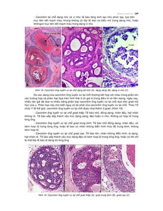 Beänh lyù tuyeán vuù 249
- Carcinoâm taïi choã daïng nhuù vaø vi nhuù: teá baøo taêng sinh taïo nhuù phöùc taïp, töïa treân
truïc lieân keát maïch maùu nhöng khoâng coù lôùp teá baøo cô bieåu moâ trong daïng nhuù, hoaëc
khoângcoù truïc lieân keát maïch maùu trong daïng vi nhuù
Hình 18: Carcinoâm oáng tuyeán vuù taïi choã daïng baõ khoâ (A), daïng saøng (B), daïng vi nhuù (C)
Do caùc daïng cuûa carcinoâm oáng tuyeán vuù taïi choã thöôøng keát hôïp vôùi nhau trong phaàn lôùn
caùc tröôøng hôïp vaø phaân loaïi döïa treân hình thaùi ít coù giaù trò trong ñieàu trò vaø tieân löôïng, ngaøy nay,
nhieàu taùc giaû ñaõ ñöa ra nhieàu baûng phaân loaïi carcinoâm oáng tuyeán vuù taïi choã döïa treân grad moâ
hoïc cuûa u. Phaân loaïi naøy cho bieát nguy cô taùi phaùt cuûa carcinoâm oáng tuyeán vuù taïi choã. Theo Toå
chöùc Y teá theá giôùi, carcinoâm oáng tuyeán vuù taïi choã ñöôïc chia thaønh 3 grad: (Hình 19)
- Carcinoâm oáng tuyeán vuù taïi choã grad thaáp: Teá baøo nhoû, ñoàng daïng, nhaân ñeàu, haït nhaân
khoâng roõ. Teá baøo saép xeáp thaønh caáu truùc daïng saøng, ñaëc hoaëc vi nhuù. Khoâng coù hoaïi töû trong
loøng oáng.
- Carcinoâm oáng tuyeán vuù taïi choã grad trung bình: Teá baøo nhoû ñoàng daïng, nhaân ñeàu, coù
keøm hoaïi töû trong loøng oáng; hoaëc teá baøo coù nhaân khoâng ñieån hình möùc ñoä trung bình, khoâng
keøm hoaïi töû.
- Carcinoâm oáng tuyeán vuù taïi choã grad cao: Teá baøo lôùn, nhaân khoâng ñieån hình, dò daïng,
haït nhaân roõ. Teá baøo xeáp thaønh caáu truùc daïng ñaëc coù keøm hoaïi töû trong loøng oáng; hoaëc coù khi chæ
laø moät lôùp teá baøo dò daïng loùt loøng oáng.
Hình 19: Carcinoâm oáng tuyeán vuù taïi choã grad thaáp (A), grad trung bình (B), grad cao (C)
 