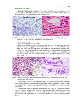Beänh lyù tuyeán vuù 250
B/ Carcinoâm xaâm nhaäp :
* Carcinoâm tieåu thuøy xaâm nhaäp (5-10%) : coù theå bò ôû caû hai beân vuù, hoaëc coù nhieàu oå
treân cuøng moät vuù. Kinh ñieån, caùc teá baøo u xeáp thaønh caùc daõy moät haøng teá baøo, khoâng taïo
oáng hoaëc taïo nhuù, xaâm nhaäp trong moâ ñeäm sôïi. (Hình 20)
Hình 20: Carcinoâm tieåu thuøy xaâm nhaäp, teá baøo u taïo thaønh caùc haøng moät, bao quanh 1 oáng tuyeán vuù bình
thöôøng (A) . Teá baøo u xaâm nhaäp, xeáp thaønh daõy moät haøng teá baøo (B).
* Carcinoâm oáng tuyeán vuù xaâm nhaäp :
- Carcinoâm oáng tuyeán vuù xaâm nhaäp daïng khoâng ñaëc hieäu (Not Otherwise Specified,
N.O.S) : laø daïng thöôøng gaëp nhaát, chieám 70-80% carcinoâm xaâm nhaäp. Teá baøo u xeáp
thaønh daây, oå ñaëc, oáng nhoû hoaëc nhieàu ñaùm noái keát vôùi nhau xaâm nhaäp trong moâ ñeäm.
Teá baøo u coù kích thöôùc thay ñoåi, töø nhöõng teá baøo nhoû coù nhaân taêng saéc trung bình ñeán
nhöõng teá baøo khoång loà coù nhaân taêng saéc meùo moù. Grad moâ hoïc cuûa u ñöôïc ñaùnh giaù
qua möùc ñoä khoâng ñieån hình cuûa nhaân teá baøo vaø khaû naêng thaønh laäp oáng tuyeán cuûa teá
baøo u. (Hình 21)
Hình 21: Carcinoâm oáng tuyeán vuù xaâm nhaäp daïng khoâng ñaëc hieäu (NOS), xaâm nhaäp vaøo moâ môõ (A); xaâm
nhaäp vaøo maïch baïch huyeát (B).
- Carcinoâm oáng tuyeán vuù xaâm nhaäp daïng nhaày : Gaëp ôû phuï nöõ lôùn tuoåi hôn, dieãn tieán
chaäm trong nhieàu naêm, tieân löôïng toát neáu khoâng keát hôïp vôùi daïng khaùc. Treân vi theå thaáy
nhöõng ñaûo teá baøo u hoaëc nhöõng oáng tuyeán naèm trong nhöõng beå nhaày lôùn baét maøu nhaït.
(Hình 22A)
- Carcinoâm oáng tuyeán vuù xaâm nhaäp daïng oáng nhoû: gaëp ôû phuï nöõ tuoåi treû hôn, moät tæ leä
nhoû coù u ôû hai beân vuù hoaëc nhieàu oå. Treân vi theå teá baøo u xeáp thaønh nhöõng oáng nhoû, loùt moät
lôùp teá baøo (khoâng coù teá baøo cô bieåu moâ), xaâm nhaäp trong moâ ñeäm (phaân bieät vôùi toån thöông
xô cöùng laønh tính, oáng tuyeán ñöôïc loùt bôûi hai lôùp teá baøo: bieåu moâ vaø cô bieåu moâ). (Hình
22B)
 