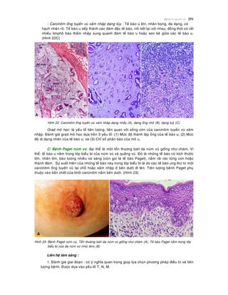 Beänh lyù tuyeán vuù 251
- Carcinoâm oáng tuyeán vuù xaâm nhaäp daïng tuûy : Teá baøo u lôùn, nhaân boïng, ña daïng, coù
haïch nhaân roõ. Teá baøo u xeáp thaønh caùc ñaùm ñaëc teá baøo, noái keát laïi vôùi nhau; ñoàng thôøi coù raát
nhieàu limphoâ baøo thaám nhaäp xung quanh ñaùm teá baøo u hoaëc xen keõ giöõa caùc teá baøo u.
(Hình 22C)
Hình 22: Carcinoâm oáng tuyeán vuù xaâm nhaäp daïng nhaày (A), daïng oáng nhoû (B), daïng tuyû (C).
Grad moâ hoïc: laø yeáu toá tieân löôïng, lieân quan vôùi soáng coøn cuûa carcinoâm tuyeán vuù xaâm
nhaäp. Ñaùnh giaù grad moâ hoïc döïa treân 3 yeáu toá: (1) Möùc ñoä thaønh laäp oáng cuûa teá baøo u; (2) Möùc
ñoä dò daïng nhaân cuûa teá baøo u; vaø (3) Chæ soá phaân baøo cuûa moâ u.
C/ Beänh Paget nuùm vuù: ñaïi theå laø moät toån thöông loeùt da nuùm vuù gioáng nhö chaøm. Vi
theå: teá baøo u naèm trong lôùp bieåu bì cuûa nuùm vuù vaø quaàng vuù. Ñoù laø nhöõng teá baøo coù kích thöôùc
lôùn, nhaân lôùn, baøo töông nhieàu vaø saùng (coøn goïi laø teá baøo Paget), naèm raûi raùc töøng con hoaëc
thaønh ñaùm. Söï xuaát hieän cuûa nhöõng teá baøo naøy trong lôùp bieåu bì laø do caùc teá baøo ung thö töø moät
carcinoâm oáng tuyeán vuù taïi choã hoaëc xaâm nhaäp ôû beân döôùi ñi leân. Tieân löôïng beänh Paget phuï
thuoäc vaøo baûn chaát cuûa khoái carcinoâm naèm beân döôùi. (Hình 23).
Hình 23: Beänh Paget nuùm vuù, Toån thöông loeùt da nuùm vuù gioáng nhö chaøm (A); Teá baøo Paget naèm trong lôùp
bieåu bì cuûa da nuùm vuù (muõi teân) (B)
Lieân heä laâm saøng :
1. Ñaùnh giaù giai ñoaïn : coù yù nghóa quan troïng giuùp löïa choïn phöông phaùp ñieàu trò vaø tieân
löôïng beänh. Ñöôïc döïa vaøo yeáu toá T, N, M.
 