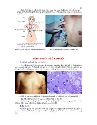 Beänh lyù tuyeán vuù 253
- Sinh thieát töùc thì (caét laïnh) : thöïc hieän trong luùc phaãu thuaät, cho keát quaû sau vaøi
phuùt, daønh cho nhöõng toån thöông nghi ngôø aùc tính maø nhöõng phöông phaùp treân chöa khaúng
ñònh ñöôïc.
Hình 24: Caùc vò trí di caên cuûa carcinoâm tuyeán vuù Hình 25: Phöông phaùp choïc huùt baèng kim nhoû
BEÄNH TUYEÁN VUÙ ÔÛ NAM GIÔÙI
1. Nöõ hoaù tuyeán vuù (Gynecomastia):
Do maát quaân bình giöõa estrogen vaø androgen (estrogen ñöôïc taïo ra ôû voû thöôïng thaän),
gaëp vaøo giai ñoaïn daäy thì hoaëc ôû tuoåi giaø bò suy chöùc naêng tinh hoaøn, hoaëc ôû ngöôøi xô gan
khoâng chuyeån hoaù ñöôïc estrogen; hoaëc lieân quan vôùi duøng röôïu, ma tuùy, thuoác taâm thaàn, …
Hình 26: Nöõ hoùa tuyeán vuù beân traùi (A); taêng sinh oáng tuyeán vuù maø khoâng taêng sinh tieåu thuyø (B)
- Ñaïi theå: moät hoaëc hai beân tuyeán vuù nôû to nhö ôû nöõ daäy thì
- Vi theå: taêng sinh oáng tuyeán vuù nhöng khoâng taêng sinh tieåu thuyø, xung quanh laø moâ lieân
keát thöa thaám nhaäp moät ít limphoâ baøo vaø töông baøo.(Hình 26)
2. Carcinoâm:
Raát hieám gaëp ôû giôùi nam, chieám 1% caùc ung thö vuù. U gaây loeùt, xaâm nhieãm da vaø thaønh
ngöïc beân döôùi. Vi theå thöôøng laø loaïi carcinoâm oáng tuyeán vuù. U di caên xa vaøo phoåi, naõo, xöông,
gan.
 