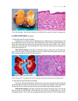 Beänh Lyù Tuyeán Giaùp 257
Hình 4: Boïc oáng giaùp - löôõi chöùa dòch vaøng ñaëc (A); loùt bôûi bieåu moâ truï giaû taàng, moâ ñeäm coù nang giaùp (B)
II. VIEÂM TUYEÁN GIAÙP (thyroiditis):
1. Vieâm giaùp caáp tính (acute thyroidits):
Thöôøng do caùc vi khuaån sinh muû (Staphylococcus, Streptococcus, Pneumococcus); moät
soá ít tröôøng hôïp do viruùt, kyù sinh truøng, naám, thöôøng xaûy ra treân cô ñòa suy giaûm mieãn dòch. Vi
khuaån ñeán tuyeán giaùp theo ñöôøng maùu, ñöôøng baïch huyeát hoaëc lan tröïc tieáp töø caùc oå nhieãm
khuaån cuûa cô quan laân caän nhö vuøng khaåu haàu, tuyeán nöôùc boït. Bieåu hieän laâm saøng goàm coù
soát vaø ñau vuøng tröôùc coå.
Hình thaùi toån thöông: Tuyeán giaùp to khoâng ñoái xöùng, coù nhieàu oå aùp xe nhoû (Hình 5).
Treân vi theå, moâ tuyeán coù phaûn öùng tieát dòch, phuø neà vaø thaám nhaäp nhieàu baïch caàu ña nhaân.
Ñieàu trò baèøng khaùng sinh vaø daãn löu oå aùp xe neáu coù.
Hình 5: OÅ aùp xe treân 1 thuøy giaùp ñaõ xeû ñoâi (A); OÅ muû goàm baïch caàu ña nhaân thoaùi hoaù vaø ñaïi thöïc baøo
2. Vieâm giaùp haït (granulomatous thyroiditis):
Coøn goïi laø vieâm giaùp de Quervain; thöôøng xaûy ra ôû phuï nöõ trung nieân vôùi trieäu chöùng soát
vaø ñau ñoät ngoät moät beân coå, coù theå lan leân tai vaø vuøng döôùi haøm. Nguyeân nhaân chöa bieát roõ
nhöng coù leõ do viruùt vì beänh thöôøng xuaát hieän sau moät nhieãm khuaån ñöôøng hoâ haáp treân.
Hình thaùi toån thöông: tuyeán giaùp to gaáp ñoâi bình thöôøng, khoâng ñoái xöùng; treân maët caét
thaáy coù nhöõng cuïc maät ñoä chaéc, maàu traéng nhaït, kích thuôùc töø vaøi milimeùt ñeán 2 cm, coù theå
troâng gioáng ung thö. Treân vi theå, caùc nang giaùp ñöôïc bao quanh bôûi caùc oå vieâm haït goàm teá baøo
 