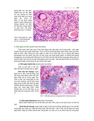 Beänh Lyù Tuyeán Giaùp 258
daïng bieåu moâ, ñaïi baøo,
limphoâ baøo vaø caùc ñaùm
moâ sôïi; khoâng coù chaát
hoaïi töû baõ ñaäu nhö trong
vieâm lao. (Hình 6).
Ñieàu trò noäi khoa baèng
aspirin, thuoác khaùng vieâm
khoâng steroid cho ñeán
khi heát trieäu chöùng. Beänh
töï giôùi haïn, hoài phuïc
hoaøn toaøn sau 1-2 thaùng
Hình 6: Vieâm giaùp haït: nang
giaùp (1; Teá baøo daïng bieåu
moâ (2) vaø ñaïi baøo (3) .
.
3. Vieâm giaùp töï mieãn (autoimmune thyroiditis):
Theo quan nieäm hieän nay, 2 loaïi vieâm giaùp tröôùc ñaây ñöôïc moâ taû rieâng bieät - vieâm giaùp
limphoâ baøo vaø vieâm giaùp Hashimoto - thöïc ra chæ laø nhöõng giai ñoaïn beänh khaùc nhau cuûa vieâm
giaùp töï mieãn. Ñaëc tröng cuûa vieâm giaùp töï mieãn laø söï xuaát hieän caùc töï khaùng theå khaùng
peroxidase (xuùc taùc phaûn öùng höõu cô hoaù muoái iod trong tuyeán giaùp), töï khaùng theå khaùng
throglobulin vaø töï khaùng theå choáng laïi thuï theå TSH treân beà maët teá baøo nang giaùp (theo kieåu öùc
cheá thuï theå), laøm cho caùc teá baøo nang giaùp bò phaù huûy daàn ; keát quaû beänh nhaân luùc khôûi beänh
thöôøng bình giaùp nhöng caøng veà sau caøng nhöôïc giaùp.
a/ Vieâm giaùp limphoâ baøo (lymphocytic thyroiditis):
Xaûy ra chuû yeáu ôû treû em,
dieãn tieán beänh thöôøng nheï vaø ngaén.
Hình thaùi toån thöông: tuyeán
giaùp hôi to, ñeàu, maät ñoä taêng, maët
caét vaøng nhaït. Beänh nhaân vaãn bình
giaùp hoaëc chæ bò nhöôïc giaùp nheï.
Treân vi theå, caùc nang giaùp coù caáu
truùc bình thöôøng, caùc teá baøo nang
giaùp chöa bò bieán ñoåi thaønh teá baøo
Hürthle (teá baøo Askanazy); moâ ñeäm
giöõa caùc nang giaùp thaám nhaäp
limphoâ baøo vaø coù theå thaáy coù söï
thaønh laäp caùc trung taâm maàm. (Hình
7)
Hình 7: Moâ ñeäm giöõa caùc nang giaùp thaám nhaäp limphoâ baøo
b/ Vieâm giaùp Hashimoto (Hashimoto’s thyroiditis):
Beänh ñöôïc Hashimoto moâ taû laàn ñaàu vaøo naêm 1912, xaûy ra chuû yeáu ôû phuï nöõ treân 40
tuoåi.
Hình thaùi toån thöông: tuyeán giaùp to gaáp 2-3 laàn bình thöôøng (40-80 gram), lan toaû ñoái
xöùng hoaëc taïo nhieàu cuïc. Maët caét vaøng nhaït, maät ñoä chaéc. Treân vi theå, moâ keõ giöõa caùc nang
giaùp thaám nhaäp raát nhieàu limphoâ baøo, töông baøo, moâ baøo vaø coù söï thaønh laäp caùc trung taâm
 