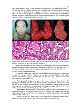 Beänh Lyù Tuyeán Giaùp 261
nang chöùa raát ít hoaëc khoâng coù chaát keo giaùp. ÔÛ nhöõng nang lôùn hôn, teá baøo nang giaùp coù
theå taêng sinh taïo nhuù thoø vaøo trong loøng nang, coù theå gaây nhaàm laãn vôùi carcinoâm tuyeán giaùp
daïng nhuù. Trong moâ ñeäm giöõa caùc nang giaùp, coù söï taêng sinh maïch maùu, thaám nhaäp limphoâ
baøo vaø coù theå coù caùc trung taâm maàm. Tình traïng loài maét trong beänh Basedow laø do hieän töôïng
phuø neà, thaám nhaäp limphoâ baøo, laéng ñoïng chaát mucopolysaccharid vaø hoaù sôïi trong caùc cô
ngoaøi nhaõn caàu vaø trong moâ ñeäm cuûa hoác maét.(Hình 11)
Hình 11: Phình giaùp loài maét (A); Tuyeán giaùp to ñeàu 2 thuyø (B); maét caét maàu ñoû (C); treân vi theå, teá baøo nang
giaùp taêng sinh taïo nhuù (D), nang giaùp chöùa ít chaát keo giaùp (E)
Beänh Basedow coù theå ñöôïc ñieàu trò baèng nhieàu phöông phaùp khaùc nhau nhö duøng thuoác
khaùng giaùp (propylthiouracil, methimazole), phaãu thuaät caét giaùp gaàn troïn, uoáng iod phoùng xaï;
tuy nhieân, taát caû caùc phöông phaùp naøy ñeàu khoâng coù taùc duïng ñoái vôùi trieäu chöùng loài maét.
C. Taêng saûn cuïc (nodular hyperplasia):
Laø loaïi beänh lyù tuyeán giaùp thöôøng gaëp nhaát; coù theå phaùt hieän treân laâm saøng ôû 3-5% ngöôøi
lôùn, 50% caùc tröôøng hôïp töû thieát. Taêng saûn cuïc thöôøng xaûy ra ôû ngöôøi treû (töø sau tuoåi daäy thì
ñeán tuoåi tröôûng thaønh), ôû giôùi nöõ nhieàu hôn giôùi nam. Tuyø theo nguyeân nhaân vaø cô cheá beänh
sinh, phaân bieät 2 loaïi taêng saûn cuïc:
- Phình giaùp dòch vuøng (endemic goiter): laø tình traïng phình giaùp xaûy ra ôû moät soá ñòa
phöông vôùi xuaát ñoä hôn 10% daân soá; thöôøng thuoäc veà caùc vuøng nuùi hoaëc vuøng naèm saâu trong
ñaát lieàn, coù haøm luôïng iod trong ñaát vaø nöôùc raát thaáp. Nguyeân nhaân gaây phình giaùp taïi nhöõng
vuøng naøy laø do söï thieáu huït iod trong thöïc phaåm, tuyeán giaùp khoâng saûn xuaát ñuû T3 vaø T4 laøm
tuyeán yeân taêng tieát TSH, kích thích tuyeán giaùp taêng saûn taïo cuïc.
- Phình giaùp leû teû (nonendemic/ sporadic goiter): laø nhöõng tröôøng hôïp phình giaùp xaûy ra
ngoaøi nhöõng vuøng ñòa dö noùi treân. Nguyeân nhaân vaø cô cheá beänh sinh cuûa loaïi phình giaùp naøy
vaãn chöa ñöôïc roõ; tuyeán giaùp khoâng saûn xuaát ñuû hormoân coù theå laø do taùc ñoäng phoái hôïp cuûa
nhieàu yeáu toá khaùc nhau nhö:
* Söû duïng caùc loaïi thöïc phaåm coù chöùa caùc chaát khaùng giaùp nhö thioglucoside (caûi baép,
cuû caûi), cyanoglucoside (boät saén, baép, khoai lang, maêng tre), flavinoid (haït keâ).
 