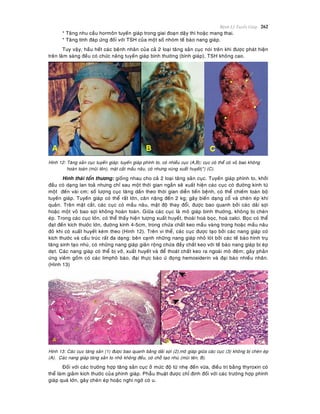 Beänh Lyù Tuyeán Giaùp 262
* Taêng nhu caàu hormoân tuyeán giaùp trong giai ñoaïn daäy thì hoaëc mang thai.
* Taêng tính ñaùp öùng ñoái vôùi TSH cuûa moät soá nhoùm teá baøo nang giaùp.
Tuy vaäy, haàu heát caùc beänh nhaân cuûa caû 2 loaïi taêng saûn cuïc noùi treân khi ñöôïc phaùt hieän
treân laâm saøng ñeàu coù chöùc naêng tuyeán giaùp bình thöôøng (bình giaùp), TSH khoâng cao.
Hình 12: Taêng saûn cuïc tuyeán giaùp: tuyeán giaùp phình to, coù nhieàu cuïc (A,B); cuïc coù theå coù voû bao khoâng
hoaøn toaøn (muõi teân), maët caét maàu naâu, coù nhöng vuøng xuaát huyeát(*) (C).
Hình thaùi toån thöông: gioáng nhau cho caû 2 loaïi taêng saûn cuïc. Tuyeán giaùp phình to, khôûi
ñaàu coù daïng lan toaû nhöng chæ sau moät thôøi gian ngaén seõ xuaát hieän caùc cuïc coù ñöôøng kính töø
moät ñeán vaøi cm; soá löôïng cuïc taêng daàn theo thôøi gian dieãn tieán beänh, coù theå chieám toaøn boä
tuyeán giaùp. Tuyeán giaùp coù theå raát lôùn, caân naëng ñeán 2 kg; gaây bieán daïng coå vaø cheøn eùp khí
quaûn. Treân maët caét, caùc cuïc coù maàu naâu, maät ñoä thay ñoåi, ñöôïc bao quanh bôûi caùc daûi sôïi
hoaëc moät voû bao sôïi khoâng hoaøn toaøn. Giöõa caùc cuïc laø moâ giaùp bình thöôøng, khoâng bò cheøn
eùp. Trong caùc cuïc lôùn, coù theå thaáy hieän töôïng xuaát huyeát, thoaùi hoaù boïc, hoaù calci. Boïc coù theå
ñaït ñeán kích thöôùc lôùn, ñöôøng kính 4-5cm, trong chöùa chaát keo maàu vaøng trong hoaëc maàu naâu
ñoû khi coù xuaát huyeát keøm theo (Hình 12). Treân vi theå, caùc cuïc ñöôïc taïo bôûi caùc nang giaùp coù
kích thöôùc vaø caáu truùc raát ña daïng: beân caïnh nhöõng nang giaùp nhoû loùt bôûi caùc teá baøo hình truï
taêng sinh taïo nhuù, coù nhöõng nang giaùp giaõn roäng chöùa ñaày chaát keo vôùi teá baøo nang giaùp bò eùp
deït. Caùc nang giaùp coù theå bò vôõ, xuaát huyeát vaø ñeå thoaùt chaát keo ra ngoaøi moâ ñeäm; gaây phaûn
öùng vieâm goàm coù caùc limphoâ baøo, ñaïi thöïc baøo öù ñoïng hemosiderin vaø ñaïi baøo nhieàu nhaân.
(Hình 13)
Hình 13: Caùc cuïc taêng saûn (1) ñöôïc bao quanh baèng daûi sôïi (2),moâ giaùp giöõa caùc cuïc (3) khoâng bò cheøn eùp
(A). Caùc nang giaùp taêng saûn to nhoû khoâng ñeàu, coù choã taïo nhuù (muõi teân, B).
Ñoái vôùi caùc tröôøng hôïp taêng saûn cuïc ôû möùc ñoä töø nheï ñeán vöøa, ñieàu trò baèng thyroxin coù
theå laøm giaûm kích thöôùc cuûa phình giaùp. Phaãu thuaät ñöôïc chæ ñònh ñoái vôùi caùc tröôøng hôïp phình
giaùp quaù lôùn, gaây cheøn eùp hoaëc nghi ngôø coù u.
 