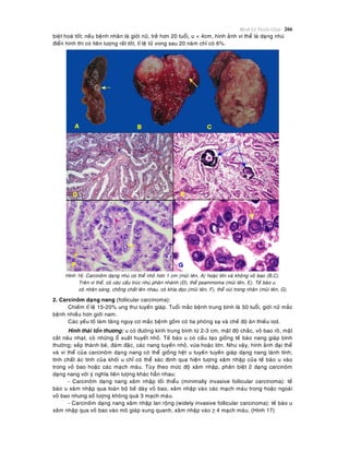 Beänh Lyù Tuyeán Giaùp 266
bieät hoaù toát; neáu beänh nhaân laø giôùi nöõ, treû hôn 20 tuoåi, u < 4cm, hình aûnh vi theå laø daïng nhuù
ñieån hình thì coù tieân löôïng raát toát, tæ leä töû vong sau 20 naêm chæ coù 6%.
Hình 16: Carcinoâm daïng nhuù coù theå nhoû hôn 1 cm (muõi teân, A) hoaëc lôùn vaø khoâng voû bao (B,C).
Treân vi theå, coù caùc caáu truùc nhuù phaân nhaùnh (D), theå psammoma (muõi teân, E). Teá baøo u
coù nhaân saùng, choàng chaát leân nhau, coù khía doïc (muõi teân, F), theå vuøi trong nhaân (muõi teân, G).
2. Carcinoâm daïng nang (follicular carcinoma):
Chieám tæ leä 15-20% ung thö tuyeán giaùp. Tuoåi maéc beänh trung bình laø 50 tuoåi, giôùi nöõ maéc
beänh nhieàu hôn giôùi nam.
Caùc yeáu toá laøm taêng nguy cô maéc beänh goàm coù tia phoùng xaï vaø cheá ñoä aên thieáu iod.
Hình thaùi toån thöông: u coù ñöôøng kính trung bình töø 2-3 cm, maät ñoä chaéc, voû bao roõ, maët
caét naâu nhaït, coù nhöõng oå xuaát huyeát nhoû. Teá baøo u coù caáu taïo gioáng teá baøo nang giaùp bình
thöôøng; xeáp thaønh beø, ñaùm ñaëc, caùc nang tuyeán nhoû, vöøa hoaëc lôùn. Nhö vaäy, hình aûnh ñaïi theå
vaø vi theå cuûa carcinoâm daïng nang coù theå gioáng heät u tuyeán tuyeán giaùp daïng nang laønh tính;
tính chaát aùc tính cuûa khoái u chæ coù theå xaùc ñònh qua hieän töôïng xaâm nhaäp cuûa teá baøo u vaøo
trong voû bao hoaëc caùc maïch maùu. Tuøy theo möùc ñoä xaâm nhaäp, phaân bieät 2 daïng carcinoâm
daïng nang vôùi yù nghóa tieân löôïng khaùc haún nhau:
- Carcinoâm daïng nang xaâm nhaäp toái thieåu (minimally invasive follicular carcinoma): teá
baøo u xaâm nhaäp qua toaøn boä beà daøy voû bao, xaâm nhaäp vaøo caùc maïch maùu trong hoaëc ngoaøi
voû bao nhöng soá löôïng khoâng quaù 3 maïch maùu.
- Carcinoâm daïng nang xaâm nhaäp lan roäng (widely invasive follicular carcinoma): teá baøo u
xaâm nhaäp qua voû bao vaøo moâ giaùp xung quanh, xaâm nhaäp vaøo ≥ 4 maïch maùu. (Hình 17)
 