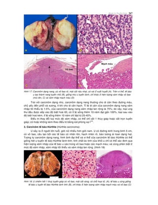 Beänh Lyù Tuyeán Giaùp 267
Hình 17: Carcinoâm daïng nang, coù voû bao roõ, maët caét naâu nhaït, coù vaøi oå xuaát huyeát (A). Treân vi theå, teá baøo
u taïo thaønh nang tuyeán nhoû (B), gioáng nhö u tuyeán laønh; chæ khaùc ôû hieän töôïng xaâm nhaäp voû bao
(muõi teân, C) vaø xaâm nhaäp maïch maùu (D)
Traùi vôùi carcinoâm daïng nhuù, carcinoâm daïng nang thöôøng cho di caên theo ñöôøng maùu,
chuû yeáu ñeán phoåi vaø xöông, ít khi cho di caên haïch. Tæ leä di caên cuûa carcinoâm daïng nang xaâm
nhaäp toái thieåu laø 1-5%, cuûa carcinoâm daïng nang xaâm nhaäp lan roäng laø 75%; do vaäy, loaïi ung
thö ñaàu ñöôïc xeáp vaøo ñoä bieät hoaù toát, coù tæ leä soáng theâm 10 naêm ñaït gaàn 100%, loaïi sau vaøo
ñoä bieät hoaù keùm, tæ leä soáng theâm 10 naêm chæ ñaït töø 25-45%.
Ñieàu trò thay ñoåi tuyø möùc ñoä xaâm nhaäp, coù theå chæ caét 1 thuøy giaùp hoaëc caét troïn tuyeán
giaùp; coù hoaëc khoâng keøm theo ñieàu trò baèng iod phoùng xaï I131
.
3. Carcinoâm teá baøo Hürthle (Hürthle carcinoma):
U xaûy ra ôû ngöôøi lôùn tuoåi, giôùi nöõ nhieàu hôn giôùi nam. U coù ñöôøng kính trung bình 5 cm,
coù voû bao, caáu taïo bôûi caùc teá baøo coù nhaân lôùn, haïch nhaân roõ, baøo töông aùi toan daïng haït.
Töông töï carcinoâm daïng nang, hình aûnh ñaïi theå vaø vi theå cuûa carcinoâm teá baøo Hürthle coù theå
gioáng heät u tuyeán teá baøo Hürthle laønh tính; tính chaát aùc tính cuûa khoái u chæ coù theå xaùc ñònh qua
hieän töôïng xaâm nhaäp cuûa teá baøo u vaøo trong voû bao hoaëc caùc maïch maùu; vaø cuõng phaân bieät 2
möùc ñoä xaâm nhaäp, xaâm nhaäp toái thieåu vaø xaâm nhaäp lan roäng. (Hình 18)
Hình 18: U chieám heát 1 thuyø tuyeán giaùp coù voû bao, maët caét vaøng, coù choã hoaïi töû, (A); teá baøo u cuõng gioáng
teá baøo u tuyeán teá baøo Hürthle laønh tính (B), chæ khaùc ôû hieän töôïng xaâm nhaäp maïch maùu vaø voû bao (C)
 