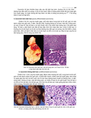 Beänh Lyù Tuyeán Giaùp 268
Carcinoâm teá baøo Hürthle ñöôïc xeáp vaøo ñoä bieät hoaù keùm, thöôøng cho di caên theo
ñöôøng maùu ñeán phoåi vaø xöông, ít cho di caên haïch. Ñieàu trò baèng phaãu thuaät caét troïn hoaëc gaàn
troïn tuyeán giaùp, coù hoaëc khoâng keát hôïp theâm vôùi ñieàu trò baèng iod phoùng xaï I131
. Tæ leä soáng
theâm 5 naêm chæ ñaït 50%.
4. Carcinoâm keùm bieät hoaù (poorly differentiated carcinoma):
Chieám tæ leä 4% ung thö tuyeán giaùp, tuoåi maéc beänh trung bình laø 55 tuoåi, giôùi nöõ maéc
beänh nhieàu hôn giôùi nam. U ñaëc, maät ñoä chaéc, thöôøng khoâng coù voû bao; maët caét u traéng xaùm,
coù caùc oå hoaïi töû. Caùc teá baøo u coù kích thöôùc nhoû, tæ leä nhaân/ baøo töông cao; tæ leä phaân baøo
taêng. Teá baøo u xeáp thaønh caùc ñaûo teá baøo ñaëïc hình troøn hoaëc baàu duïc, chöùa ít chaát keo. U
thöôøng cho di caên haïch vaø di caên xa theo ñöôøng maùu ñeán gan vaø xöông; vaøo thôøi ñieåm u ñöôïc
phaùt hieän, 36% soá beänh nhaân ñaõ coù di caên haïch vaø 26% coù di caên xa. Ñaây laø loaïi ung thö coù
tieân löôïng xaáu, tæ leä töû vong cao (Hình 19).
Hình 19: Carcinoâm keùm bieät hoaù: maët caét traêng xaùm, coù oå hoaïi töû (A). Teá baøo
u hôïp thaønh ñaùm ñaëc hình troøn (B).
5. Carcinoâm khoâng bieät hoaù (undifferentiated carcinoma):
Chieám tæ leä 1-10% ung thö tuyeán giaùp. Beänh nhaân thöôøng lôùn tuoåi, trung bình laø 65 tuoåi,
giôùi nöõ maéc beänh nhieàu hôn giôùi nam. U phaùt trieån nhanh, chieám toaøn boä tuyeán giaùp, xaâm nhaäp
ra ngoaøi gaây khoù thôû vaø khoù nuoát; cho di caên theo ñöôøng baïch huyeát vaø ñöôøng maùu. U ñaëc,
cöùng chaéc, khoâng voû bao, maët caét traéng xaùm, coù nhieàu oå hoaïi töû vaø xuaát huyeát. Caùc teá baøo u
coù theå coù hình ña dieän nhö teá baøo gai, hình thoi nhö teá baøo sôïi, hoaëc gioáng ñaïi baøo nhieàu nhaân;
nhaân dò daïng, tæ leä phaân baøo raát cao. (Hình 20)
Hình 20: Carcinoâm khoâng bieät hoaù: u raát lôùn, maët caét nhieàu oå hoaïi töû xuaát huyeát (A), treân vi theå, goàm caùc
teá baøo u dò daïng, phaân baøo baát thöôøng (muõi teân, B)
 