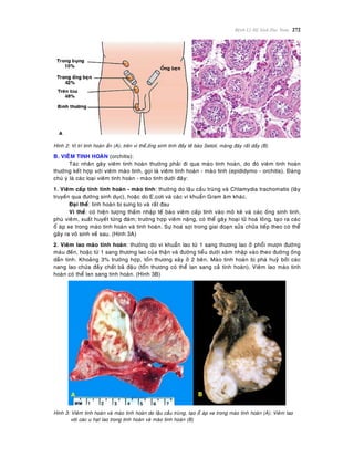Beänh Lyù Heä Sinh Duïc Nam 272
Hình 2: Vò trí tinh hoaøn aån (A); treân vi theå,oáng sinh tinh ñaày teá baøo Setoli, maøng ñaùy raát daày (B)
B. VIEÂM TINH HOAØN (orchitis):
Taùc nhaân gaây vieâm tinh hoaøn thöôøng phaûi ñi qua maøo tinh hoaøn, do ñoù vieâm tinh hoaøn
thöôøng keát hôïp vôùi vieâm maøo tinh, goïi laø vieâm tinh hoaøn - maøo tinh (epididymo - orchitis). Ñaùng
chuù yù laø caùc loaïi vieâm tinh hoaøn - maøo tinh döôùi ñaây:
1. Vieâm caáp tính tinh hoaøn - maøo tinh: thöôøng do laäu caàu truøng vaø Chlamydia trachomatis (laây
truyeàn qua ñöôøng sinh duïc), hoaëc do E.coli vaø caùc vi khuaån Gram aâm khaùc.
Ñaïi theå: tinh hoaøn bò söng to vaø raát ñau
Vi theå: coù hieän töôïng thaám nhaäp teá baøo vieâm caáp tính vaøo moâ keõ vaø caùc oáng sinh tinh,
phuø vieâm, xuaát huyeát töøng ñaùm; tröôøng hôïp vieâm naëng, coù theå gaây hoaïi töû hoaù loûng, taïo ra caùc
oå aùp xe trong maøo tinh hoaøn vaø tinh hoaøn. Söï hoaù sôïi trong giai ñoaïn söûa chöõa tieáp theo coù theå
gaây ra voâ sinh veà sau. (Hình 3A)
2. Vieâm lao maøo tinh hoaøn: thöôøng do vi khuaån lao töø 1 sang thöông lao ôû phoåi möôïn ñöôøng
maùu ñeán, hoaëc töø 1 sang thöông lao cuûa thaän vaø ñöôøng tieåu döôùi xaâm nhaäp vaøo theo ñöôøng oáng
daãn tinh. Khoaûng 3% tröôøng hôïp, toån thöông xaûy ôû 2 beân. Maøo tinh hoaøn bò phaù huyû bôûi caùc
nang lao chöùa ñaày chaát baõ ñaäu (toån thöông coù theå lan sang caû tinh hoaøn). Vieâm lao maøo tinh
hoaøn coù theå lan sang tinh hoaøn. (Hình 3B)
Hình 3: Vieâm tinh hoaøn vaø maøo tinh hoaøn do laäu caàu truøng, taïo oå aùp xe trong maøo tinh hoaøn (A); Vieâm lao
vôùi caùc u haït lao trong tinh hoaøn vaø maøo tinh hoaøn (B)
 