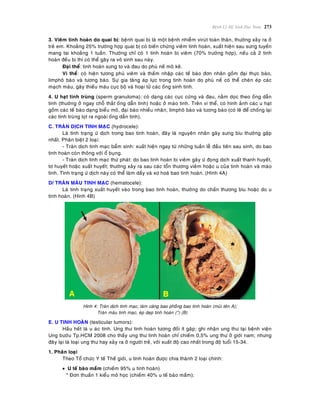 Beänh Lyù Heä Sinh Duïc Nam 273
3. Vieâm tinh hoaøn do quai bò: beänh quai bò laø moät beänh nhieãm viruùt toaøn thaân, thöôøng xaûy ra ôû
treû em. Khoaûng 25% tröôøng hôïp quai bò coù bieán chöùng vieâm tinh hoaøn, xuaát hieän sau söng tuyeán
mang tai khoaûng 1 tuaàn. Thöôøng chæ coù 1 tinh hoaøn bò vieâm (70% tröôøng hôïp), neáu caû 2 tinh
hoaøn ñeàu bò thì coù theå gaây ra voâ sinh sau naøy.
Ñaïi theå: tinh hoaøn söng to vaø ñau do phuø neà moâ keõ.
Vi theå: coù hieän töông phuø vieâm vaø thaám nhaäp caùc teá baøo ñôn nhaân goàm ñaïi thöïc baøo,
limphoâ baøo vaø töông baøo. Söï gia taêng aùp löïc trong tinh hoaøn do phuø neà coù theå cheøn eùp caùc
maïch maùu, gaây thieáu maùu cuïc boä vaø hoaïi töû caùc oáng sinh tinh.
4. U haït tinh truøng (sperm granuloma): coù daïng caùc cuïc cöùng vaø ñau, naèm doïc theo oáng daãn
tinh (thöôøng ôû ngay choã thaét oáng daãn tinh) hoaëc ôû maøo tinh. Treân vi theå, coù hình aûnh caùc u haït
goàm caùc teá baøo daïng bieåu moâ, ñaïi baøo nhieàu nhaân, limphoâ baøo vaø töông baøo (coù leõ ñeå choáng laïi
caùc tinh truøng loït ra ngoaøi oáng daãn tinh).
C. TRAØN DÒCH TINH MAÏC (hydrocele):
Laø tình traïng öù dòch trong bao tinh hoaøn, ñaây laø nguyeân nhaân gaây söng bìu thöôøng gaëp
nhaát. Phaân bieät 2 loaïi:
- Traøn dòch tinh maïc baåm sinh: xuaát hieän ngay töø nhöõng tuaàn leã ñaàu tieân sau sinh, do bao
tinh hoaøn coøn thoâng vôùi oå buïng.
- Traøn dòch tinh maïc thöù phaùt: do bao tinh hoaøn bò vieâm gaây öù ñoïng dòch xuaát thanh huyeát,
tô huyeát hoaëc xuaát huyeát; thöôøng xaûy ra sau caùc toån thöông vieâm hoaëc u cuûa tinh hoaøn vaø maøo
tinh. Tình traïng öù dòch naøy coù theå laøm daày vaø xô hoaù bao tinh hoaøn. (Hình 4A)
D/ TRAØN MAÙU TINH MAÏC (hematocele):
Laø tinh traïng xuaát huyeát vaøo trong bao tinh hoaøn, thöôøng do chaán thöông bìu hoaëc do u
tinh hoaøn. (Hình 4B)
Hình 4: Traøn dòch tinh maïc, laøm caêng bao phoàng bao tinh hoaøn (muõi teân A);
Traøn maùu tinh maïc, eùp deïp tinh hoaøn (*) (B)
E. U TINH HOAØN (testicular tumors):
Haàu heát laø u aùc tính. Ung thö tinh hoaøn töông ñoái ít gaëp; ghi nhaän ung thö taïi beänh vieän
Ung böôùu Tp.HCM 2008 cho thaáy ung thö tinh hoaøn chæ chieám 0,5% ung thö ôû giôùi nam; nhöng
ñaây laïi laø loaïi ung thö hay xaûy ra ôû ngöôøi treû, vôùi xuaát ñoâï cao nhaát trong ñoä tuoåi 15-34.
1. Phaân loaïi
Theo Toå chöùc Y teá Theá giôùi, u tinh hoaøn ñöôïc chia thaønh 2 loaïi chính:
 U teá baøo maàm (chieám 95% u tinh hoaøn)
* Ñôn thuaàn 1 kieåu moâ hoïc (chieám 40% u teá baøo maàm):
 