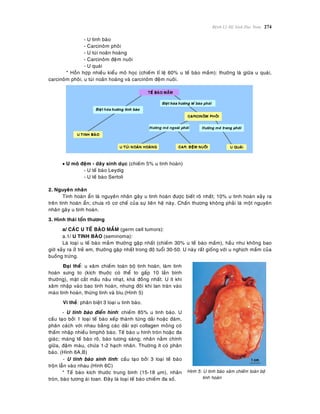 Beänh Lyù Heä Sinh Duïc Nam 274
- U tinh baøo
- Carcinoâm phoâi
- U tuùi noaõn hoaøng
- Carcinoâm ñeäm nuoâi
- U quaùi
* Hoãn hôïp nhieàu kieåu moâ hoïc (chieám tæ leä 60% u teá baøo maàm): thöôøng laø giöõa u quaùi,
carcinoâm phoâi, u tuùi noaõn hoaøng vaø carcinoâm ñeäm nuoâi.
 U moâ ñeäm - daây sinh duïc (chieám 5% u tinh hoaøn)
- U teá baøo Leydig
- U teá baøo Sertoli
2. Nguyeân nhaân
Tinh hoaøn aån laø nguyeân nhaân gaây u tinh hoaøn ñöôïc bieát roõ nhaát; 10% u tinh hoaøn xaûy ra
treân tinh hoaøn aån; chöa roõ cô cheá cuûa söï lieân heä naøy. Chaán thöông khoâng phaûi laø moät nguyeân
nhaân gaây u tinh hoaøn.
3. Hình thaùi toån thöông
a/ CAÙC U TEÁ BAØO MAÀM (germ cell tumors):
a.1/ U TINH BAØO (seminoma):
Laø loaïi u teá baøo maàm thöôøng gaëp nhaát (chieám 30% u teá baøo maàm), haàu nhö khoâng bao
giôø xaûy ra ôû treû em, thöôøng gaëp nhaát trong ñoä tuoåi 30-50. U naøy raát gioáng vôùi u nghòch maàm cuûa
buoàng tröùng.
Ñaïi theå: u xaâm chieám toaøn boä tinh hoaøn, laøm tinh
hoaøn söng to (kích thuôùc coù theå to gaáp 10 laàn bình
thöôøng), maët caét maàu naâu nhaït, khaù ñoàng nhaát. U ít khi
xaâm nhaäp vaøo bao tinh hoaøn, nhöng ñoâi khi lan traøn vaøo
maøo tinh hoaøn, thöøng tinh vaø bìu.(Hình 5)
Vi theå: phaân bieät 3 loaïi u tinh baøo.
- U tinh baøo ñieån hình: chieám 85% u tinh baøo. U
caáu taïo bôûi 1 loaïi teá baøo xeáp thaønh töøng daûi hoaëc ñaùm,
phaân caùch vôùi nhau baèng caùc daûi sôïi collagen moûng coù
thaám nhaäp nhieàu limphoâ baøo. Teá baøo u hình troøn hoaëc ña
giaùc; maøng teá baøo roõ, baøo töông saùng; nhaân naèm chính
giöõa, ñaäm maøu, chöùa 1-2 haïch nhaân. Thöôøng ít coù phaân
baøo. (Hình 6A,B)
- U tinh baøo sinh tinh: caáu taïo bôûi 3 loaïi teá baøo
troän laãn vaøo nhau (Hình 6C)
* Teá baøo kích thöôùc trung bình (15-18 µm), nhaân
troøn, baøo töông aùi toan. Ñaây laø loaïi teá baøo chieám ña soá.
Hình 5: U tinh baøo xaâm chieám toaøn boä
tinh hoaøn
 