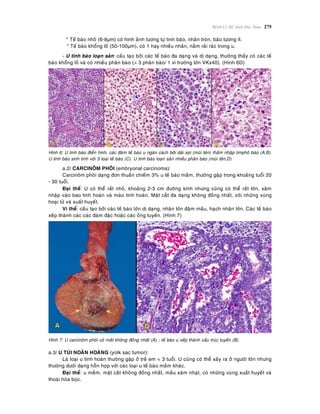 Beänh Lyù Heä Sinh Duïc Nam 275
* Teá baøo nhoû (6-8µm) coù hình aûnh töông töï tinh baøo, nhaân troøn, baøo töông ít.
* Teá baøo khoång loà (50-100µm), coù 1 hay nhieàu nhaân, naèm raûi raùc trong u.
- U tinh baøo loaïn saûn: caáu taïo bôûi caùc teá baøo ña daïng vaø dò daïng, thöôøng thaáy coù caùc teá
baøo khoång loà vaø coù nhieàu phaân baøo (> 3 phaân baøo/ 1 vi tröôøng lôùn VKx40). (Hình 6D)
Hình 6: U tinh baøo ñieån hình, caùc ñaùm teá baøo u ngaên caùch bôûi daûi sôïi (muõi teân) thaám nhaäp limphoâ baøo (A,B).
U tinh baøo sinh tinh vôùi 3 loaïi teá baøo (C). U tinh baøo loaïn saûn nhieàu phaân baøo (muõi teân,D)
a.2/ CARCINOÂM PHOÂI (embryonal carcinoma):
Carcinoâm phoâi daïng ñôn thuaàn chieám 3% u teá baøo maàm, thöôøng gaëp trong khoaûng tuoåi 20
- 30 tuoåi.
Ñaïi theå: U coù theå raát nhoû, khoaûng 2-3 cm ñöôøng kính nhöng cuõng coù theå raát lôùn, xaâm
nhaäp vaøo bao tinh hoaøn vaø maøo tinh hoaøn. Maët caét ña daïng khoâng ñoàng nhaát, vôùi nhöõng vuøng
hoaïi töû vaø xuaát huyeát.
Vi theå: caáu taïo bôûi caùc teá baøo lôùn dò daïng, nhaân lôùn ñaäm maàu, haïch nhaân lôùn. Caùc teá baøo
xeáp thaønh caùc caùc ñaùm ñaëc hoaëc caùc oáng tuyeán. (Hình 7)
Hình 7: U carcinoâm phoâi coù maét khoâng ñoàng nhaát (A) ; teá baøo u xeáp thaønh caáu truùc tuyeán (B).
a.3/ U TUÙI NOAÕN HOAØNG (yolk sac tumor):
Laø loaïi u tinh hoaøn thöôøng gaëp ôû treû em < 3 tuoåi. U cuõng coù theå xaûy ra ôû ngöôøi lôùn nhöng
thöôøng döôùi daïng hoãn hôïp vôùi caùc loaïi u teá baøo maàm khaùc.
Ñaïi theå: u meàm, maët caét khoâng ñoàng nhaát, maàu xaùm nhaït, coù nhöõng vuøng xuaát huyeát vaø
thoaùi hoùa boïc.
 