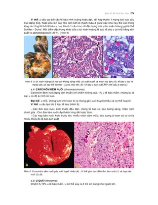 Beänh Lyù Heä Sinh Duïc Nam 276
Vi theå: u caáu taïo bôûi caùc teá baøo hình vuoâng hoaëc deït, keát hôïp thaønh 1 maïng löôùi caùc caáu
truùc daïng oáng, hoaëc phuû leân caùc nhuù lieân keát coù maïch maùu ôû giöõa; caùc nhuù naøy thoø vaøo trong
loøng caùc oáng loùt bôûi teá baøo u, taïo thaønh 1 caáu truùc raát ñaëc tröng cuûa u tuùi noaõn hoaøng goïi laø theå
Schiller - Duval. Moät ñieàm ñaëc tröng khaùc cuûa u tuùi noaõn hoaøng laø caùc teá baøo u coù khaû naêng saûn
xuaát ra alphafetoprotein (AFP). (Hình 8)
Hình 8: U tuùi noaõn hoaøng coù maët caét khoâng ñoàng nhaát, coù xuaát huyeát vaø thoaùi hoaù boïc (A); teá baøo u taïo ra
maïng löôùi, coù caùc theå Schiller - Duval (muõi teân, B); Teá baøo u saûn xuaát AFP (theà caàu aùi toan,C)
a.4/ CARCINOÂM ÑEÄM NUOÂI (choriocarcinoma):
Carcinoâm ñeäm nuoâi daïng ñôn thuaàn chæ chieám khoâng quaù 1% u teá baøo maàm, nhöng laïi laø
loaïi u coù ñoä aùc tính raát cao.
Ñaïi theå: u nhoû, khoâng laøm tinh hoaøn to ra nhöng gaây xuaát huyeát nhieàu vaø coù theå hoaïi töû.
Vi theå: u caáu taïo bôûi 2 loaïi teá baøo (Hình 9):
- Caùc ñôn baøo nuoâi, kích thöôùc ñeàu ñaën, maøng teá baøo roõ, baøo töông saùng; nhaân naèm
chính göõa . Caùc ñôn baøo nuoâi xeáp thaønh töøng daûi hoaëc ñaùm.
- Caùc hôïp baøo nuoâi, kích thöôùc lôùn, nhieàu nhaân ñaäm maàu; baøo töông aùi toan vaø coù chöùa
nhieàu HCG do teá baøo saûn xuaát.
Hình 9: U carcinoâm ñeäm nuoâi gaây xuaát huyeát nhieàu (A) ; Vi theå goàm caùc ñaùm ñôn baøo nuoâi (1) vaø hôïp baøo
nuoâi (2) (B).
a.5/ U QUAÙI (teratoma):
Chieám 5-10% u teá baøo maàm. U coù theå xaûy ra ôû treû em cuõng nhö ngöôøi lôùn.
 