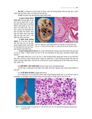 Beänh Lyù Heä Sinh Duïc Nam 277
Ñaïi theå: u thöôøng coù kích thöôùc 5-10cm; maët caét khoâng ñoàng nhaát do caáu taïo u goàm
nhieàu loaïi moâ khaùc nhau, coù nhöõng vuøng hoaù boïc.
Vi theå: tuyø theo möùc ñoä bieät hoaù, phaân bieät 3 loaïi.
- U quaùi tröôûng thaønh
laønh tính: thöôøng gaëp ôû treû
em hôn laø ngöôøi lôùn. U caáu
taïo bôûi nhieàu loaïi moâ tröôûng
thaønh xuaát phaùt töø caû 3 laù
phoâi: moâ thaàn kinh, moâ cô,
suïn, xöông, caùc loaïi bieåu moâ
phuû vaø bieåu moâ tuyeán. Caùc
loaïi moâ khaùc nhau naøy saép
xeáp loän xoän treân neàn 1 moâ
ñeäm sôïi hoaëc moâ nieâm.
- U quaùi chöa tröôûng
thaønh: laø u aùc tính, caáu taïo
bôûi caùc loaïi moâ vaø teá baøo
chöa tröôûng thaønh xuaát phaùt
töø 3 laù phoâi nhö moâ suïn non,
caùc nguyeân baøo thaàn kinh...
Hình 10 : Maët caét u quaùi tröôûng thaønh coù vuøng ñaëc vaø vuøng thoaùi hoaù
boïc (A) ; vi theå coù moâ thaàn ñeäm (1), tuyeán (2) vaø caùc boù cô trôn (3) (B).
- U quaùi tröôûng thaønh hoaù aùc: laø u quaùi tröôûng thaønh nhöng trong thaønh phaàn caáu taïo cuûa
noù laïi coù chöùa 1 thaønh phaàn aùc tính roõ reät nhö carcinoâm teá baøo gai, caùrcinoâm tuyeán hoaëc
sarcoâm.
Moät ñieåm ñaùng chuù yù laø ôû treû em, u quaùi thöôøng thuoäc daïng ñôn thuaàn vaø coù theå laønh
tính neáu vi theå laø u quaùi tröôûng thaønh; khaùc vôùi ngöôøi lôùn, u quaùi thöôøng laø daïng hoãn hôïp vôùi
nhieàu u teá baøo maàm khaùc, cho neân duø vi theå laø loaïi u quaùi tröôûng thaønh thì vaãn ñöôïc xem nhö aùc
tính. (Hình 10)
b/ U MOÂ ÑEÄM - DAÂY SINH DUÏC (tumor of sex cord - gonadal stroma):
Laø caùc loaïi u xuaát phaùt töø moâ ñeäm cuûa tuyeán sinh duïc nguyeân thuûy, quan troïng nhaát laø 2
loaïi sau:
b.1/ U TEÁ BAØO LEYDIG (Leydig cell tumor):
U coù theå xaûy ra ôû moïi löùa tuoåi, nhieàu nhaát trong khoaûng 20-60 tuoåi. U coù theå saûn xuaát ra
androgen vaø estrogen, gaây ra trieäu chöùng nöõ hoaù tuyeán vuù hoaëc daäy thì sôùm ôû treû em.
Hình 11: U teá baøo Leydig(*) coù giôùi haïn roõ, maët caét maâu naâu (A); tinh theå Reinke trong baøo töông teá baøo
u (muõi teân, B)
 