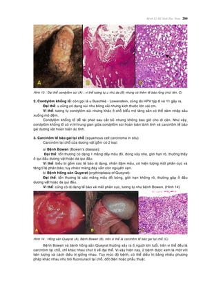 Beänh Lyù Heä Sinh Duïc Nam 280
Hình 13 : Ñaïi theå condyloâm suøi (A) ; vi theå töông töï u nhuù da (B) nhöng coù theâm teá baøo roãng (muõi teân, C)
2. Condyloâm khoång loà: coøn goïi laø u Buschkeù - Lowenstein, cuõng do HPV tyùp 6 vaø 11 gaây ra.
Ñaïi theå: u cuõng coù daïng suøi nhö boâng caûi nhöng kích thöôùc lôùn vaøi cm.
Vi theå: töông töï condyloâm suøi nhöng khaùc ôû choãø bieåu moâ taêng saûn coù theå xaâm nhaäp saâu
xuoáng moâ ñeäm.
Condyloâm khoång loà deã taùi phaùt sau caét boû nhöng khoâng bao giôø cho di caên. Nhö vaäy,
condyloâm khoång loà coù vò trí trung gian giöõa condyloâm suøi hoaøn toaøn laønh tính vaø carcinoâm teá baøo
gai döông vaät hoaøn toaøn aùc tính.
3. Carcinoâm teá baøo gai taïi choã (squamous cell carcinoma in situ)
Carcinoâm taïi choå cuûa döông vaät goàm coù 2 loaïi:
a/ Beänh Bowen (Bowen’s disease):
Ñaïi theå: toån thöông coø daïng 1 maûng daày maàu ñoû, ñoùng vaûy nheï, giôùi haïn roõ, thöôøng thaáy
ôû qui ñaàu döông vaät hoaëc da qui ñaàu.
Vi theå: bieåu bì goàm caùc teá baøo dò daïng, nhaân ñaäm maàu, coù hieän töôïng maát phaân cöïc vaø
taêng tæ leä phaân baøo; tuy nhieân maøng ñaùy vaãn coøn nguyeân veïn.
b/ Beänh Hoàng saûn Quyerat (erythroplasia of Queyrat):
Ñaïi theå: toån thöông laø caùc maûng maàu ñoû boùng, giôùi haïn khoâng roõ, thöôøng gaëp ôû ñaàu
döông vaät hoaëc da qui ñaàu.
Vi theå: cuõng coù dò daïng teá baøo vaø maát phaân cöïc, töông töï nhö beänh Bowen. (Hình 14)
Hình 14 : Hoàng saûn Queyrat (A), Beänh Bowen (B), treân vi theå laø carcinoâm teá baøo gai taïi choã (C)
Beänh Bowen vaø beänh hoàng saûn Queyrat thöôøng xaûy ra ôû ngöôøi lôùn tuoåi, treân vi theå ñeàu laø
carcinoâm taïi choã, chæ khaùc nhau chuùt ít veà ñaïi theå. Vì vaäy hieän nay, 2 beänh ñöôïc xem laø moät vôùi
tieân löôïng vaø caùch ñieàu trò gioáng nhau. Tuøy möùc ñoä beänh, coù theå ñieàu trò baèng nhieàu phöông
phaùp khaùc nhau nhö boâi fluorouracil taïi choã, ñoát ñieän hoaëc phaãu thuaät.
 