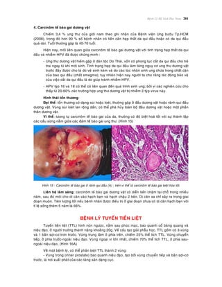 Beänh Lyù Heä Sinh Duïc Nam 281
4. Carcinoâm teá baøo gai döông vaät
Chieám 3,4 % ung thö cuûa giôùi nam theo ghi nhaän cuûa Beänh vieän Ung böôùu Tp.HCM
(2008), trong ñoù hôn 90 % soá beänh nhaân coù tieàn caên heïp thaét da qui ñaàu hoaëc coù da qui ñaàu
quaù daøi. Tuoåi thöôøng gaëp laø 40-70 tuoåi.
Hieän nay, moái lieân quan giöõa carcinoâm teá baøo gai döông vaät vôùi tình traïng heïp thaét da qui
ñaàu vaø nhieãm HPV ñaõ ñöôïc chöùng minh :
- Ung thö döông vaät hieám gaëp ôû daân toäc Do Thaùi, voán coù phong tuïc caét da qui ñaàu cho treû
trai ngay töø khi môùi sinh. Tình traïng heïp da qui ñaàu laøm taêng nguy cô ung thö döông vaät
tröôùc ñaây ñöôïc cho laø do veä sinh keùm vaø do caùc taùc nhaân sinh ung chöùa trong chaát caën
cuûa bao qui ñaàu (chaát smegma); tuy nhieân hieän nay ngöôøi ta cho raèng taùc ñoäng baûo veä
cuûa vieäc caét da qui ñaàu laø do giuùp traùnh nhieãm HPV.
- HPV tyùp 16 vaø 18 coù theå coù lieân quan ñeán quaù trình sinh ung; bôûi vì caùc nghieân cöùu cho
thaáy töø 20-60% caùc tröôøng hôïp ung thö döông vaät bò nhieãm 2 tyùp virus naøy.
Hình thaùi toån thöông:
Ñaïi theå: toån thöông coù daïng suøi hoaëc loeùt, thöôøng gaëp ôû ñaàu döông vaät hoaëc raõnh qui ñaàu
döông vaät. Vuøng suøi loeùt lan roäng daàn, coù theå phaù huûy toaøn boä ñaàu döông vaät hoaëc moät phaàn
thaân döông vaät.
Vi theå: töông töï carcinoâm teá baøo gai cuûa da, thöôøng coù ñoä bieät hoaù toát vôùi söï thaønh laäp
caùc caàu söøng naèm giöõa caùc ñaùm teá baøo gai ung thö. (Hình 15)
Hình 15 : Carcinoâm teá baøo gai ôû raõnh qui ñaàu (A) ; treân vi theå laø carcinoâm teá baøo gai bieät hoùa toát.
Lieân heä laâm saøng: carcinoâm teá baøo gai döông vaät coù dieãn tieán chaäm taïi choã trong nhieàu
naêm, sau ñoù môùi cho di caên vaøo haïch beïn vaø haïch chaäu 2 beân. Di caên xa chæ xaûy ra trong giai
ñoaïn muoän. Tieân löôïng toát neáu beänh nhaân ñöôïc ñieàu trò ôû giai ñoaïn chöa coù di caên haïch beïn vôùi
tæ leä soáng theâm 5 naêm laø 66%.
BEÄNH LYÙ TUYEÁN TIEÀN LIEÄT
Tuyeán tieàn lieät (TTL) hình noùn ngöôïc, naèm sau phuùc maïc, bao quanh coå baøng quang vaø
nieäu ñaïo, ôû ngöôøi tröôøng thaønh naëng khoaûng 20g. Veà caáu taïo giaûi phaãu hoïc, TTL goàm coù 3 vuøng
vaø 1 baûn sôïi-cô trôn tröôùc. Vuøng trung taâm ôû phía treân, chieám 25% theå tích TTL. Vuøng chuyeån
tieáp, ôû phía tröôùc-ngoaøi nieäu ñaïo. Vuøng ngoaïi vi lôùn nhaát, chieám 70% theå tích TTL, ôû phía sau-
ngoaøi nieäu ñaïo. (Hình 16A)
Veà maët beänh lyù, coù theå phaân bieät TTL thaønh 2 vuøng:
- Vuøng trong (inner prostate) bao quanh nieäu ñaïo, taïo bôûi vuøng chuyeån tieáp vaø baûn sôïi-cô
tröôùc, laø nôi xuaát phaùt cuûa caùc taêng saûn daïng cuïc.
 