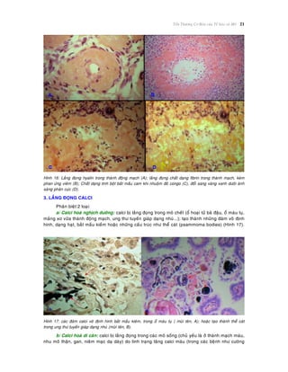 Toån Thöông Cô Baûn cuûa Teá baøo vaø Moâ 21
Hình 16: Laéng ñoïng hyalin trong thaønh ñoäng maïch (A); laéng ñoïng chaát daïng fibrin trong thaønh maïch, keøm
phan öùng vieâm (B); Chaát daïng tinh boät baét maàu cam khi nhuoäm ñoû congo (C), ñoåi sang vaøng xanh döôùi aùnh
saùng phaân cöïc (D).
3. LAÉNG ÑOÏNG CALCI
Phaân bieät 2 loaïi:
a/ Calci hoaù nghòch döôõng: calci bò laéng ñoïng trong moâ cheát (oå hoaïi töû baõ ñaäu, oå maùu tuï,
maûng xô vöõa thaønh ñoäng maïch, ung thö tuyeán giaùp daïng nhuù...); taïo thaønh nhöõng ñaùm voâ ñònh
hình, daïng haït, baét maàu kieàm hoaëc nhöõng caáu truùc nhö theå caùt (psammoma bodies) (Hình 17).
Hình 17: caùc ñaùm calci voâ ñònh hình baét maàu kieâm, trong oå maùu tuï ( muõi teân, A); hoaëc taïo thaønh theå caùt
trong ung thö tuyeán giaùp daïng nhuù (muõi teân, B).
b/ Calci hoaù di caên: calci bò laéng ñoïng trong caùc moâ soáng (chuû yeáu laø ôû thaønh maïch maùu,
nhu moâ thaän, gan, nieâm maïc daï daøy) do tình traïng taêng calci maùu (trong caùc beänh nhö cöôøng
 