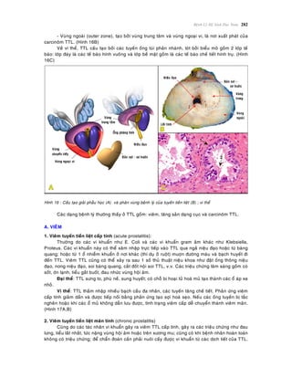 Beänh Lyù Heä Sinh Duïc Nam 282
- Vuøng ngoaøi (outer zone), taïo bôûi vuøng trung taâm vaø vuøng ngoaïi vi, laø nôi xuaát phaùt cuûa
carcinoâm TTL. (Hình 16B)
Veà vi theå, TTL caáu taïo bôûi caùc tuyeán oáng tuùi phaân nhaùnh, loùt bôûi bieåu moâ goàm 2 lôùp teá
baøo: lôùp ñaùy laø caùc teá baøo hình vuoâng vaø lôùp beà maët goàm laø caùc teá baøo cheá tieát hình truï. (Hình
16C)
Hình 16 : Caáu taïo giaûi phaãu hoïc (A) vaø phaân vuøng beänh lyù cuûa tuyeán tieàn lieät (B) ; vi theå
Caùc daïng beänh lyù thöôøng thaáy ôû TTL goàm: vieâm, taêng saûn daïng cuïc vaø carcinoâm TTL.
A. VIEÂM
1. Vieâm tuyeán tieàn lieät caáp tính (acute prostatitis):
Thöôøng do caùc vi khuaån nhö E. Coli vaø caùc vi khuaån gram aâm khaùc nhö Klebsiella,
Proteus. Caùc vi khuaån naøy coù theå xaâm nhaäp tröïc tieáp vaøo TTL qua ngaû nieäu ñaïo hoaëc töø baøng
quang; hoaëc töø 1 oå nhieãm khuaån ôû nôi khaùc (thí duï ôû ruoät) muôïn ñöôøng maùu vaø baïch huyeát ñi
ñeán TTL. Vieâm TTL cuõng coù theå xaûy ra sau 1 soá thuû thuaät nieäu khoa nhö ñaët oáng thoâng nieäu
ñaïo, nong nieäu ñaïo, soi baøng quang, caét ñoát noäi soi TTL, v.v. Caùc trieäu chöùng laâm saøng goàm coù
soát, ôùn laïnh, tieåu gaét buoát, ñau nhöùc vuøng hoäi aâm.
Ñaïi theå: TTL söng to, phuø neà, sung huyeát; coù choã bò hoaïi töû hoaù muû taïo thaønh caùc oå aùp xe
nhoû.
Vi theå: TTL thaám nhaäp nhieàu baïch caàu ña nhaân, caùc tuyeán taêng cheá tieát. Phaûn öùng vieâm
caáp tính giaûm daàn vaø ñöôïc tieáp noái baèng phaûn öùng taïo sôïi hoaù seïo. Neáu caùc oáng tuyeán bò taéc
ngheõn hoaëc khi caùc oå muû khoâng daãn löu ñöôïc, tình traïng vieâm caáp deã chuyeån thaønh vieâm maõn.
(Hình 17A,B)
2. Vieâm tuyeán tieàn lieät maõn tính (chronic prostatitis)
Cuõng do caùc taùc nhaân vi khuaån gaây ra vieâm TTL caáp tính, gaây ra caùc trieäu chöùng nhö ñau
löng, tieåu laét nhaét, töùc naëng vuøng hoäi aâm hoaëc treân xöông mu; cuõng coù khi beänh nhaân hoaøn toaøn
khoâng coù trieäu chöùng; ñeå chaån ñoaùn caàn phaûi nuoâi caáy ñöôïc vi khuaån töø caùc dòch tieát cuûa TTL.
 