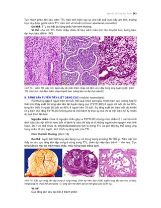 Beänh Lyù Heä Sinh Duïc Nam 283
Tuy nhieân phaàn lôùn caùc vieâm TTL maõn tính hieän nay laïi cho keát quaû nuoâi caáy aâm tính, tröôøng
hôïp naøy ñöôïc goïi laø vieâm TTL maõn tính voâ khuaån (chronic abacterial prostatitis).
Ñaïi theå: TTL coù maät ñoä cöùng chaéc hôn bình thöôøng.
Vi theå: nhu moâ TTL thaám nhaäp nhieàu teá baøo vieâm maõn tính nhö limphoâ baøo, töông baøo,
ñaïi thöïc baøo. (Hình 17C)
Hình 15 : Vieâm TTL caáp tính, baïch caàu ña nhaân thaám nhaäp moâ ñeäm vaø öù ñaày trong loøng tuyeán (A,B). Vieâm
TTL maõn tính, moâ ñeäm thaám nhaäp limphoâ baøo, töông baøo vaø ñaïi thöïc baøo(C).
B. TAÊNG SAÛN TUYEÁN TIEÀN LIEÄT DAÏNG CUÏC (nodular hyperplasia):
Raát thöôøng gaëp ôû ngöôøi treân 50 tuoåi. Keát quaû khaûo saùt ngaãu nhieân treân caùc tröôøng hôïp töû
thieát cho thaáy xuaát ñoä taêng saûn tieàn lieät tuyeán daïng cuïc (TSTTLDC) ôû ngöôøi 40 tuoåi chæ coù 20%,
taêng leân 70% ôû ngöôøi 60 tuoåi vaø 90% ôû ngöôøi treân 70 tuoåi. Söï taêng xuaát ñoä theo tuoåi taùc khieán
coù yù kieán cho raèng TSTTLDC khoâng phaûi laø moät beänh lyù thöïc söï maø chæ laø moät bieán ñoåi töï nhieân
do quaù trình laõo hoaù.
Nguyeân nhaân: chöa roõ nguyeân nhaân gaây ra TSTTLDC nhöng chaéc chaén coù 1 vai troø nhaát
ñònh cuûa caùc noäi tieát toá nam, bôûi vì beänh lyù naøy chæ xaûy ra ôû nhöõng ngöôøi coøn nguyeân veïn tinh
hoaøn. Do 1 cô cheá chöa roõ, dihydrotestosterone tích tuï trong TTL vaø gaén leân thuï theå töông öùng
trong nhaân teá baøo tuyeán, kích thích söï taêng saûn cuûa TTL.
Hình thaùi toån thöông: (Hình 16)
Ñaïi theå: tuyeán tieàn lieät taêng saûn daïng cuïc coù troïng löôïng khoaûng 60-100 gr. Treân maët caét
thaáy roõ caùc cuïc taêng saûn taäp trung ôû vuøng trong TTL, cheøn eùp nieäu ñaïo thaønh 1 khe heïp. Cuïc
taêng saûn coù maät ñoä meàm hoaëc chaéc, maàu hoàng hoaëc traéng xaùm.
Hình 16: Caùc cuïc taêng saûn taäp trung ôû vuøng trong, cheøn eùp nieäu ñaïo (A,B); tuyeán taêng saûn taïo nhuù vaø boïc,
trong loøng coù chöùa theå amylacea (*); taêng saûn moâ ñeäm sôïi-cô trôn giöõa caùc tuyeán (C).
Vi theå:
Cuïc taêng saûn caáu taïo bôûi 2 thaønh phaàn:
 