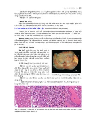 Beänh Lyù Heä Sinh Duïc Nam 284
- Caùc tuyeán taêng saûn taïo nhuù, boïc. Tuyeán ñöôïc loùt bôûi bieåu moâ goàm 2 lôùp teá baøo, trong
loøng tuyeán coù chöùa nhieàu theå amylacea (do chaát tieát coâ ñaëc laïi taïo thaønh), theå naøy coù theå bò laéng
ñoïng calci thaønh soûi TTL.
- Moâ ñeäm sôïi - cô trôn taêng saûn.
Lieân heä laâm saøng:
Nieäu ñaïo bò cheøn eùp bôûi caùc cuïc taêng saûn laøm beänh nhaân tieåu khoù hoaëc bí tieåu. Nöôùc tieåu
öù laïi coù theå gaây giaõn baøng quang, thaän öù nöôùc, vieâm thaän vaø suy thaän.
C. CARCINOÂM TUYEÁN TUYEÁN TIEÀN LIEÄT (adenocarcinoma of the prostate):
Thöôøng xaûy ra ôû ngöôøi > 50 tuoåi. Ghi nhaän ung thö trong khoaûng thôøi gian töø 2004 ñeán
2008 taïi Beänh vieän Ung Böôùu Tp.HCM vaø Beänh vieän K Haø noäi cho thaáy ung thö TTL ñöùng thöù 7
vaø thöù 9 trong 10 loaïi ung thö thöôøng gaëp ôû giôùi nam,
Nguyeân nhaân: chöa roõ nhöng chaéc chaén coù vai troø cuûa caùc noäi tieát toá nam trong söï phaùt
trieån cuûa carcinoâm TTL; baèng chöùng laø ung thö naøy khoâng bao giôø xaûy ra ôû ngöôøi ñaõ bò thieán
hoaïn tröôùc tuoåi daäy thì. Ung thö naøy cuõng ít gaëp ôû nhöõng ngöôøi coù tình traïng taêng estrogen (thí
duï do xô gan).
Hình thaùi toån thöông
Ñaïi theå: phaàn lôùn ung thö xuaát phaùt töø
vuøng ngoaøi cuûa TTL, nhaát laø ôû maët sau (nhôø vaäy
coù theå phaùt hieän qua thaêm khaùm tröïc traøng). U coù
maàu traéng xaùm hoaëc vaøng nhaït, maät ñoä chaéc, giôùi
haïn khoâng roõ, treân maët caét coù theå thaáy nhieàu oå
hoaïi töû. (Hình 17):
Vi theå: thay ñoåi tuøy theo möùc ñoä bieät hoaù.
- Ñoä bieät hoaù toát: u caáu taïo bôûi caùc tuyeán
nhoû ñoàng daïng naèm chen chuùc nhau; tuyeán chæ
ñöôïc loùt bôûi 1 lôùp teá baøo (thay vì 2 lôùp nhö bình
thöôøng). Teá baøo coù nhaân lôùn, taêng saéc, haïch
nhaân roõ, baøo töông coù theå lôït hoaëc ñaäm maàu hôn
bình thöôøng.
Hình 17: OÅ ung thö naèm trong vuøng ngoaøi TTL.
- Ñoä bieät hoaù vöøa: teá baøo ung thö xeáp thaønh caùc tuyeán to nhoû khoâng ñeàu, meùo moù, coù
daïng saøng.
- Ñoä bieät hoaù keùm: teá baøo ung thö xeáp thaønh caùc beø hoaëc ñaùm ñaëc, thöôøng coù hoaïi töû
trung taâm.(Hình 18)
Hình 18: Carcinoâm TTL bieät hoaù toát (A); bieät hoaù vöøa (B); bieät hoaù keùm,teá baøo u xeáp thaønh ñaùm ñaëc (C); bieät
hoaù keùm coù hoaïi töû trung taâm (*) ,D)
 