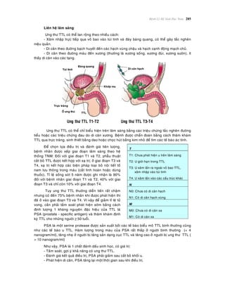 Beänh Lyù Heä Sinh Duïc Nam 285
Lieân heä laâm saøng:
Ung thö TTL coù theå lan roäng theo nhieàu caùch:
- Xaâm nhaäp tröïc tieáp qua voû bao vaøo tuùi tinh vaø ñaùy baøng quang, coù theå gaây taéc ngheõn
nieäu quaûn.
- Di caên theo ñöôøng baïch huyeát ñeán caùc haïch vuøng chaäu vaø haïch caïnh ñoäng maïch chuû.
- Di caên theo ñöôøng maùu ñeán xöông (thöôøng laø xöông soáng, xöông ñuøi, xöông söôøn), ít
thaáy di caên vaøo caùc taïng.
Ung thö TTL coù theå chæ bieåu hieän treân laâm saøng baèng caùc trieäu chöùng taéc ngheõn ñöôøng
tieåu hoaëc caùc trieäu chöùng ñau do di caên xöông. Beänh ñöôïc chaån ñoaùn baèng caùch thaêm khaùm
TTL qua tröïc traøng, sinh thieát baèng dao hoaëc choïc huùt baèng kim nhoû ñeå tìm caùc teá baøo aùc tính.
Ñeå choïn löïa ñieàu trò vaø ñaùnh giaù tieân löôïng,
beänh nhaân ñöôïc xeáp giai ñoaïn laâm saøng theo heä
thoáng TNM: Ñoái vôùi giai ñoaïn T1 vaø T2, phaãu thuaät
caét boû TTL ñöôïc keát hôïp vôùi xaï trò; ôû giai ñoaïn T3 vaø
T4, xaï trò keát hôïp caùc bieän phaùp loaïi boû noäi tieát toá
nam löu thoâng trong maùu (caét tinh hoaøn hoaëc duøng
thuoác). Tæ leä soáng soùt 5 naêm ñöôïc ghi nhaän laø 90%
ñoái vôùi beänh nhaân giai ñoaïn T1 vaø T2, 40% vôùi giai
ñoaïn T3 vaø chæ coøn 10% vôùi giai ñoaïn T4.
Tuy ung thö TTL thöôøng dieãn tieán raát chaäm
nhöng coù ñeán 75% beänh nhaân khi ñöôïc phaùt hieän thì
ñaõ ôû vaøo giai ñoaïn T3 vaø T4. Vì vaäy ñeå giaûm tæ leä töû
vong, caàn phaûi taàm soaùt phaùt hieän sôùm baèng caùch
ñònh löôïng 1 khaùng nguyeân ñaëc hieäu cuûa TTL laø
PSA (prostate - specific antigen) vaø thaêm khaùm ñònh
kyø TTL cho nhöõng ngöôøi ≥ 50 tuoåi.
T
T1: Chöa phaùt hieän u treân laâm saøng
T2: U giôùi haïn trong TTL
T3: U xaâm laán ra ngoaøi voû bao TTL,
xaâm nhaäp vaøo tuùi tinh
T4: U xaâm laán vaøo caùc caáu truùc khaùc
N
N0: Chöa coù di caên haïch
N1: Coù di caên haïch vuøng
M
M0: Chöa coù di caên xa
M1: Coù di caên xa
PSA laø moät serine protease ñöôïc saûn xuaát bôûi caùc teá baøo bieåu moâ TTL bình thöôøng cuõng
nhö caùc teá baøo u TTL. Haøm löôïng trong maùu cuûa PSA raát thaáp ôû ngöôøi bình thöôøng (< 4
nanogram/ml), taêng nheï ôû ngöôøi bò taêng saûn daïng cuïc TTL vaø taêng cao ôû ngöôøi bò ung thö TTL (
> 10 nanogram/ml)
Nhö vaäy, PSA laø 1 chaát ñaùnh daáu sinh hoïc, coù giaù trò:
- Taàm soaùt, gôïi yù khaû naêng coù ung thö TTL.
- Ñaùnh giaù keát quaû ñieàu trò, PSA phaûi giaûm sau caét boû khoái u.
- Phaùt hieän di caên, PSA taêng laïi moät thôøi gian sau khi ñieàu trò.
 