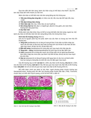 Beänh lyù Thaän 289
Döïa treân dieãn tieán laâm saøng, beänh caàu thaän cuõng coù theå ñöôïc chia thaønh: caáp tính,
baùn caáp (hoaëc tieán trieån nhanh) vaø maõn tính.
Beänh caàu thaän coù theå bieåu hieän treân laâm saøng baèng caùc hoäi chöùng sau:
1. Tieåu maùu khoâng ñau töøng ñôït, coù nhieàu möùc ñoä: tieåu maùu ñaïi theå hoaëc tieåu maùu
vi theå.
2. Tieåu ñaïm khoâng trieäu chöùng
3. Vieâm thaän caáp: tieåu maùu, thieåu nieäu vaø cao huyeát aùp.
4. Hoäi chöùng thaän hö: tieåu ñaïm > 3,5g/24 giôø, albumin-maùu giaûm, phuø toaøn thaân,
thöôøng keøm taêng lipid-maùu
5. Suy thaän maõn
Nhieàu beänh caàu thaän khaùc nhau coù theå coù cuøng moät bieåu hieän laâm saøng; ngöôïc laïi, moät
beänh caàu thaän coù theå bieåu hieän treân laâm saøng baèng nhieàu hoäi chöùng khaùc nhau.
Hình thaùi toån thöông chung (Hình 3):
Cho duø laø nguyeân phaùt hay thöù phaùt, beänh cuûa caàu thaän coù chung caùc hình thaùi toån
thöông sau:
1. Taêng sinh (proliferative) khi coù taêng soá löôïng teá baøo ôû caàu thaän do thaám nhaäp caùc
baïch caàu ña nhaân vaø ñaïi thöïc baøo hoaëc do taêng sinh caùc teá baøo ôû caàu thaän (teá baøo
gian mao maïch, teá baøo noäi moâ, teá baøo bieåu moâ).
2. Bieán ñoåi maøng (membranous) khi maøng ñaùy caùc mao maïch caàu thaän daøy leân.
3. Taêng sinh – maøng (membranoproliferative) khi phoái hôïp caû hai ñaëc ñieåm treân
4. Lieàm (crescentic) khi coù taêng saûn maïnh caùc teá baøo bieåu moâ laù ngoaøi bao Bowman
keøm thaám nhaäp caùc mono baøo, taïo thaønh moät lieàm teá baøo, ñeø eùp caùc buùi mao maïch
cuûa caàu thaän.
5. Hoaù xô (sclerosis) khi coù taêng soá löôïng chaát ngoaïi baøo coù caáu truùc vaø thaønh phaàn
hoaù hoïc töông töï maøng ñaùy vaø chaát neàn cuûa moâ ñeäm gian mao maïch.
Caùc toån thöông naøy coù theå: lan toaû khi  50% caàu thaän bò toån thöông; khu truù khi < 50%
caùc caàu thaän bò toån thöông; toaøn boä khi haàu heát caùc quai mao maïch caàu thaän ñeàu bò toån thöông;
hoaëc moät phaàn khi chæ coù moät soá quai mao maïch caàu thaän bò toån thöông (Hình 4).
Ñeå chaån ñoaùn chính xaùc beänh lyù caàu thaän, ngoaøi phöông phaùp nhuoäm thöôøng quy
Hematoxylin-eosin, thöôøng phaûi caàn ñeán caùc phöông phaùp nhuoäm ñaëc bieät ( PAS, Trichrome,
nhuoäm baïc) vaø mieãn dòch huyønh quang, coù khi caû kính hieån vi ñieän töû.
Hình 3 : Caùc hình thaùi toån thöông ôû caàu thaän Hình 4 : Möùc ñoä toån thöông ôû caàu thaän
 