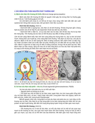 Beänh lyù Thaän 290
I. CAÙC BEÄNH CAÀU THAÄN NGUYEÂN PHAÙT THÖÔØNG GAËP
A. Beänh caàu thaän toån thöông toái thieåu (Minimal change glomerulopathy):
Beänh caàu thaän toån thöông toái thieåu laø nguyeân nhaân gaây hoäi chöùng thaän hö thöôøng gaëp
nhaát ôû treû em. Tuoåi thöôøng gaëp laø 2-6 tuoåi.
Cô cheá beänh sinh chöa roõ, coù theå do roái loaïn chöùc naêng mieãn dòch daãn ñeán saûn xuaát
cytokine laøm hoûng chaân cuûa tuùc baøo, keát quaû beänh nhaân tieåu ra protein.
Hình thaùi toån thöông: (Hình 5)
- Döôùi kính hieån vi quang hoïc, caàu thaän coù veû bình thöôøng. Teá baøo oáng löôïn gaàn öù ñoïng
lipid vaø protein (do coá taùi haáp thu caùc lipoprotein thoaùt vaøo dòch loïc caàu thaän).
- Döôùi kính hieån vi ñieän töû, coù söï xoaù chaân caùc tuùc baøo, laøm teá baøo naøy nhö bò aùp chaët
leân maøng ñaùy. Toån thöông cuûa tuùc baøo coù theå hoài phuïc sau ñieàu trò baèng corticoid.
Lieân heä laâm saøng: Beänh bieåu hieän treân laâm saøng baèng hoäi chöùng thaän hö, xaûy ra treân treû khoeû
maïnh, khoâng keøm cao huyeát aùp, chöùc naêng thaän bình thöôøng. Tieåu ñaïm coù choïn loïc, chuû yeáu laø
albumin. Beänh ôû treû em coù tieân löôïng toát. Ñieàu trò baèng corticoid, 90% beänh nhaân coù ñaùp öùng;
tuy nhieân 2/3 beänh nhaân seõ bò tieåu ñaïm taùi phaùt. Khoaûng 5% seõ dieãn tieán tôùi suy thaän sau 25
naêm. Beänh ôû ngöôøi lôùn coù ñaùp öùng vôùi ñieàu trò baèng corticoid, nhöng tæ leä taùi phaùt cao hôn. Neáu
beänh nhaân coù trieäu chöùng taêng ureâ maùu thì coù khaû naêng ñaõ bò xô hoùa caàu thaän moät phaàn-khu
truù hoaëc bò toån thöông toái thieåu keøm vieâm thaän-moâ keõ do thuoác.
Hình 5 : Sô ñoà beänh caàu thaän toån thöông toái thieåu (A); Caáu truùc caàu thaän vaãn bình thöôøng, chæ coù tuùc baøo bò
maát chaân, nhuoäm PAS (B); tình traïng maát chaân thaáy roõ döôùi KHVÑT (C)
B. Xô hoaù caàu thaän moät phaàn – khu truù (Focal segmental glomerulosclerosis, FSGS):
Xô hoaù caàu thaän moät phaàn-khu truù coù theå xuaát hieän:
- Nguyeân phaùt vaø thöôøng laø voâ caên.
- Thöù phaùt sau moät soá beänh lyù taïi thaän hoaëc ngoaøi thaän nhö tình traïng giaûm toång khoái
nhu moâ thaän baåm sinh ( voâ taïo 1 thaän) hoaëc maéc phaûi ( trong beänh thaän traøo ngöôïc), beänh tim
baåm sinh tím, nhieãm HIV, duøng thuoác Pamidronate.
Baát keå nguyeân nhaân naøo, trong beänh xô hoaù caàu thaän moät phaàn-khu truù, luoân thaáy coù toån
thöông caùc tuùc baøo. Caàu thaän bò xô hoaù töøng phaàn laø do hieän töôïng taêng tính thaám ñoái vôùi caùc
protein vaø lipid huyeát töông, daãn ñeán tình traïng laéng ñoïng hyalin trong moâ ñeäm gian mao maïch.
Hình thaùi toån thöông: (Hình 6)
- Toån thöông khu truù ôû moät soá caàu thaän, vaø moãi caàu thaän chæ coù moät soá caùc quai mao
maïch bò toån thöông xô hoaù, caùc quai mao maïch khaùc vaãn bình thöôøng. Vuøng xô hoaù coù theå ôû
gaàn cöïc maïch, cöïc nieäu vaø coù theå dính vaøo bao Bowman. Moâ ñeäm gian mao maïch taêng kích
 