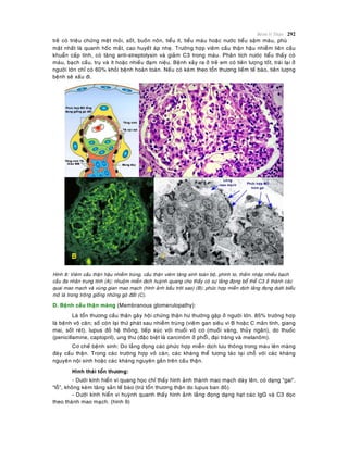 Beänh lyù Thaän 292
treû coù trieäu chöùng meät moûi, soát, buoàn noân, tieåu ít, tieåu maùu hoaëc nöôùc tieåu saäm maøu, phuø
maët nhaát laø quanh hoác maét, cao huyeát aùp nheï. Tröôøng hôïp vieâm caàu thaän haäu nhieãm lieân caàu
khuaån caáp tính, coù taêng anti-streptolysin vaø giaûm C3 trong maùu. Phaân tích nöôùc tieåu thaáy coù
maùu, baïch caàu, truï vaø ít hoaëc nhieàu ñaïm nieäu. Beänh xaûy ra ôû treû em coù tieân löôïng toát, traùi laïi ôû
ngöôøi lôùn chæ coù 60% khoûi beänh hoaøn toaøn. Neáu coù keøm theo toån thöông lieàm teá baøo, tieân löôïng
beänh seõ xaáu ñi.
Hình 8: Vieâm caàu thaän haäu nhieãm truøng, caàu thaän vieâm taêng sinh toaøn boä, phình to, thaám nhaäp nhieàu baïch
caàu ña nhaân trung tính (A); nhuoäm mieãn dòch huyønh quang cho thaáy coù söï laéng ñoïng boå theå C3 ôû thaønh caùc
quai mao maïch vaø vuøng gian mao maïch (hình aûnh baàu trôøi sao) (B); phöùc hôïp mieãn dòch laéng ñoïng döôùi bieåu
moâ laù trong troâng gioáng nhöõng goø ñaát (C).
D. Beänh caàu thaän maøng (Membranous glomerulopathy):
Laø toån thöông caàu thaän gaây hoäi chöùng thaän hö thöôøng gaëp ôû ngöôøi lôùn. 85% tröôøng hôïp
laø beänh voâ caên; soá coøn laïi thöù phaùt sau nhieãm truøng (vieâm gan sieâu vi B hoaëc C maõn tính, giang
mai, soát reùt), lupus ñoû heä thoáng, tieáp xuùc vôùi muoái voâ cô (muoái vaøng, thuûy ngaân), do thuoác
(penicillamine, captopril), ung thö (ñaëc bieät laø carcinoâm ôû phoåiø, ñaïi traøng vaø melanoâm).
Cô cheá beänh sinh: Do laéng ñoïng caùc phöùc hôïp mieãn dòch löu thoâng trong maùu leân maøng
ñaùy caàu thaän. Trong caùc tröôøng hôïp voâ caên, caùc khaùng theå töông taùc taïi choã vôùi caùc khaùng
nguyeân noäi sinh hoaëc caùc khaùng nguyeân gaén treân caàu thaän.
Hình thaùi toån thöông:
- Döôùi kính hieån vi quang hoïc chæ thaáy hình aûnh thaønh mao maïch daøy leân, coù daïng “gai”,
“loã”, khoâng keøm taêng saûn teá baøo (tröø toån thöông thaän do lupus ban ñoû).
- Döôùi kính hieån vi huyønh quanh thaáy hình aûnh laéng ñoïng daïng haït caùc IgG vaø C3 doïc
theo thaønh mao maïch. (hình 9)
 