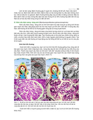 Beänh lyù Thaän 294
Lieân heä laâm saøng: Beänh thöôøng gaëp ôû ngöôøi lôùn, khoaûng 30-50 tuoåi. Nam maéc beänh
nhieàu hôn nöõ. Beänh tieán trieån aâm thaàm. Beänh nhaân coù hoäi chöùng thaän hö, tieåu ñaïm khoâng choïn
loïc: maát caû albumin vaø globulin. Beänh thöôøng khoâng ñaùp öùng vôùi ñieàu trò baèng corticoid. Maëc duø
60% beänh nhaân coù trieäu chöùng tieåu ñaïm keùo daøi nhöng chæ coù 40% tröôøng hôïp dieãn tieán tôùi suy
thaän do xô hoaù caàu thaän trong voøng töø 2 ñeán 20 naêm.
D. Vieâm caàu thaän maøng - taêng sinh (Membranoproliferative glomerulonephritis):
Vieâm caàu thaän maøng - taêng sinh coù hình aûnh beänh hoïc ñaëc tröng laø söï taêng sinh teá baøo
gian maïch caàu thaän, laéng ñoïng döôùi noäi moâ mao maïch vaø hình aûnh “vieàn ñoâi” ôû maøng ñaùy caàu
thaän, baát thöôøng veà boå theå C3 vaø thöôøng giaûm noàng ñoä C3 trong huyeát thanh.
Vieâm caàu thaän maøng - taêng sinh ñöôïc chia thaønh hai tyùp chính laø I vaø II döïa treân söï khaùc
bieät sieâu caáu truùc, mieãn dòch huyønh quang vaø beänh sinh. Ña soá vieâm caàu thaän maøng - taêng sinh
thuoäc veà tyùp I, tyùp II töông ñoái hieám gaëp. Tyùp I thöôøng xaûy ra thöù phaùt sau nhieãm truøng, beänh töï
mieãn, coù phöùc hôïp mieãn dòch tuaàn hoaøn, khoái u hoaëc nguyeân phaùt (khoâng roõ nguyeân nhaân). Tyùp
II lieân quan ñeán caùc baát thöôøng veà hoaït ñoäng cuûa heä thoáng boå theå vaø coù theå coù vai troø cuûa yeáu
toá di truyeàn.
Hình thaùi toån thöông:
- Döôùi kính hieån vi quang hoïc, tyùp I vaø II coù hình thaùi toån thöông gioáng nhau: taêng saûn teá
baøo gian mao maïch, thaám nhaäp baïch caàu, maøng ñaùy daøy leân laøm noåi baät caáu truùc tieåu thuøy cuûa
caàu thaän. Thaønh mao maïch caàu thaän coù hình aûnh “vieàn ñoâi” (double-contour) thaáy roõ khi nhuoäm
baïc hoaëc nhuoäm PAS. Hình aûnh naøy do caùc teá baøo gian mao maïch thoø caùc nhaùnh baøo töông
cuûa chuùng chen vaøo giöõa caùc quai mao maïch. (Hình 11)
Hình 11 : Sô ñoà vaø hình aûnh sieâu vi theå cuûa vieâm caàu thaän-maøng taêng sinh tyùp I (A1,A2), tyùp II (B1,B2).
maøng ñaùy caàu thaän daøy vaø daïng “vieàn ñoâi” thaáy roõ treân pheùp nhuoäm baïc. Caáu truùc tieåu thuyø noåi baät do
maøng ñaùy daày leân (C). Hình aûnh vieàn ñoâi (muõi teân) khi nhuoäm baïc (D).
- Döôùi kính hieån vi huyønh quang vaø kính hieån vi ñieän töû, tyùp I vaø II coù hình aûnh toån thöông
khaùc nhau:
 
