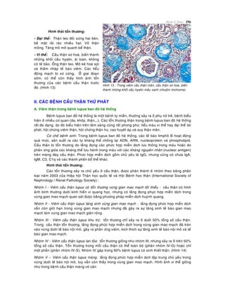 Beänh lyù Thaän 296
Hình thaùi toån thöông:
- Ñaïi theå: Thaän teo ñoái xöùng hai beân,
beà maët raûi raùc nhieàu haït. Voû thaän
moûng. Taêng moâ môõ quanh beå thaän.
- Vi theå: Caàu thaän xô hoaù, bieán thaønh
nhöõng khoái caàu hyalin, aùi toan, khoâng
coù teá baøo. OÁng thaän teo. Moâ keõ hoaù sôïi
vaø thaám nhaäp teá baøo vieâm. Caùc tieåu
ñoäng maïch bò xô cöùng. ÔÛ giai ñoaïn
sôùm, coù theå coøn thaáy hình aûnh toån
thöông cuûa caùc beänh caàu thaän tröôùc
ñoù. (Hình 13)
Hình 13 : Trong vieâm caàu thaän maõn, caàu thaän xô hoaù, bieán
thaønh nhöõng khoái caàu hyalin maàu xanh (nhuoäm trichrome)
II. CAÙC BEÄNH CAÀU THAÄN THÖÙ PHAÙT
A. Vieâm thaän trong beänh lupus ban ñoû heä thoáng
Beänh lupus ban ñoû heä thoáng laø moät beänh töï mieãn, thöôøng xaûy ra ôû phuï nöõ treû, beänh bieåu
hieän ôû nhieàu cô quan (da, khôùp, thaän,…). Caùc toån thöông thaän trong beänh lupus ban ñoû heä thoáng
raát ña daïng, do ñoù bieåu hieän treân laâm saøng cuõng raát phong phuù: tieåu maùu vi theå hay ñaïi theå taùi
phaùt, hoäi chöùng vieâm thaän, hoäi chöùng thaän hö, cao huyeát aùp vaø suy thaän maõn.
Cô cheá beänh sinh: Trong beänh lupus ban ñoû heä thoáng, caùc teá baøo limphoâ B hoaït ñoäng
quaù möùc, saûn xuaát ra caùc töï khaùng theå choáng laïi ADN, ARN, nucleoprotein vaø phospholipid.
Caàu thaän bò toån thöông do laéng ñoïng caùc phöùc hôïp mieãn dòch löu thoâng trong maùu hoaëc do
phaûn öùng giöõa caùc khaùng theå löu haønh trong maùu vôùi caùc khaùng nguyeân nhaân (nuclear antigen)
treân maøng ñaùy caàu thaän. Phöùc hôïp mieãn dòch goàm chuû yeáu laø IgG, nhöng cuõng coù chöùa IgA,
IgM, C3, C1q vaø caùc thaønh phaàn boå theå khaùc.
Hình thaùi toån thöông:
Caùc toån thöông xaûy ra chuû yeáu ôû caàu thaän, ñöôïc phaân thaønh 6 nhoùm theo baûng phaân
loaïi naêm 2003 cuûa Hieäp hoäi Thaän hoïc quoác teá vaø Hoäi Beänh hoïc thaän (International Society of
Nephrology / Renal Pathology Society) :
Nhoùm I - Vieâm caàu thaän lupus coù toån thöông vuøng gian mao maïch toái thieåu : caàu thaän coù hình
aûnh bình thöôøng döôùi kính hieån vi quang hoïc, nhöng coù laéng ñoïng phöïc hôïp mieãn dòch trong
vuøng gian mao maïch quan saùt ñöôïc baèng phöông phaùp mieãn dòch huyønh quang.
Nhoùm II - Vieâm caàu thaän lupus taêng sinh vuøng gian mao maïch : laéng ñoïng phöùc hôïp mieãn dòch
vaãn coøn giôùi haïn trong vuøng gian mao maïch nhöng ñaõ gaây ra söï taêng sinh teá baøo gian mao
maïch laøm vuøng gian mao maïch giaõn roäng.
Nhoùm III - Vieâm caàu thaän lupus khu truù: toån thöông chæ xaûy ra ôû döôùi 50% toång soá caàu thaän.
Trong caàu thaän toån thöông, laéng ñoïng phöùc hôïp mieãn dòch trong vuøng gian mao maïch ñaõ traøn
vaøo vuøng döôùi teá baøo noäi moâ, gaây ra phaûn öùng vieâm, kích thích söï taêng sinh teá baøo noäi moâ vaø teá
baøo gian mao maïch.
Nhoùm IV - Vieâm caàu thaän lupus lan toûa: toån thöông gioáng nhö nhoùm III, nhöng xaûy ra ôû treân 50%
toång soá caàu thaän. Toån thöông trong moãi caàu thaän coù theå toaøn boä (phaân nhoùm IV-G) hoaëc chæ
moät phaàn (phaân nhoùm IV-S). Nhoùm IV gaëp trong 60% beänh lupus coù sinh thieát thaän. (Hình 14)
Nhoùm V – Vieâm caàu thaän lupus maøng: laéng ñoïng phöùc hôïp mieãn dòch taäp trung chuû yeáu trong
vuøng döôùi teá baøo noäi moâ, tuy vaãn coøn thaáy trong vuøng gian mao maïch. Hình aûnh vi theå gioáng
nhö trong beänh caàu thaän maøng voâ caên
 