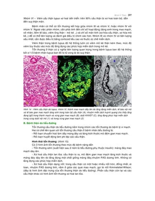 Beänh lyù Thaän 297
Nhoùm VI – Vieâm caàu thaän lupus xô hoaù tieán trieån: treân 90% caàu thaän bò xô hoaù toaøn boä, daãn
ñeán suy thaän maõn.
Beänh nhaân coù theå coù toån thöông keát hôïp giöõa nhoùm III vaø nhoùm V, hoaëc nhoùm IV vôùi
nhoùm V. Ngoaøi vieäc phaân nhoùm, caàn phaûi tính ñeán chæ soá hoaït ñoäng (taêng sinh trong mao maïch,
vôõ nhaân, lieàm teá baøo, vieâm oáng thaän - moâ keõ …) vaø chæ soá maõn tính (xô hoùa caàu thaän, xô hoùa moâ
keõ…) ñeå coù theå tieân löôïng vaø ñaùnh giaù ñieàu trò chính xaùc hôn. Nhoùm III vaø nhoùm IV coù tieân löôïng
xaáu nhaát, caàn ñöôïc ñieàu trò baèng corticoid lieàu cao vaø thuoác öùc cheá mieãn dòch.
Vieâm thaän trong beänh lupus ñoû heä thoáng luoân coù vieâm moâ keõ thaän keøm theo, möùc ñoä
vieâm tuøy thuoäc vaøo möùc ñoä laéng ñoïng caùc phöùc hôïp mieãn dòch trong moâ keõ.
Toån thöông ôû thaän coù yù nghóa tieân löôïng quan troïng trong beänh lupus ban ñoû heä thoáng
bôûi vì 1/3 beänh nhaân lupus ban ñoû bò töû vong laø do suy thaän.
Hình 14 : Vieâm caàu thaän do lupus, nhoùm IV; thaønh mao maïch daày leân do laéng ñoïng mieãn dòch, teá baøo noäi moâ
vaø teá baøo gian mao maïch taêng sinh trong toaøn boä caàu thaän (A); nhuoäm mieãn dòch huyønh quang cho thaáy laéng
ñoïng IgG trong thaønh maïch vaø vuøng gian mao maïch (B); döôùi KHVÑT (C), laéng ñoïng phöïc hôïp mieãn dòch
trong vuøng döôùi noäi moâ (1) vaø trong vuøng gian mao maïch (2).
B. Beänh thaän do tieåu ñöôøng
Toån thöông caàu thaän do tieåu ñöôøng naèm trong nhoùm caùc toån thöông do beänh lyù vi maïch.
Hai cô cheá lieân quan vôùi toån thöông caàu thaän ôû beänh nhaân tieåu ñöôøng laø:
- Roái loaïn chuyeån hoaù laøm daày maøng ñaùy vaø taêng kích thöôùc moâ ñeäm gian mao maïch.
- Roái loaïn huyeát ñoäng laøm phì ñaïi caùc caàu thaän.
Hình thaùi toån thöông: (Hình 15)
Coù 3 hình aûnh toån thöông theo möùc ñoä beänh naëng daàn
- Toån thöông sôùm (xuaát hieän sau 2 naêm bò tieåu ñöôøng phuï thuoäc insulin): maøng ñaùy mao
maïch daøy leân.
- Xô hoaù caàu thaän lan toûa: caàu thaän to ra, moâ ñeäm gian mao maïch taêng kích thöôùc vaø
maøng ñaùy daøy leân do laéng ñoïng moät chaát gioáng maøng ñaùy,nhuoäm PAS döông tính. Khoâng coù
laéng ñoïng caùc phöùc hôïp mieãn dòch.
- Xô hoaù caàu thaän daïng noát: trong caàu thaän coù moät hoaëc nhieàu noát troøn, ñoàng nhaát, aùi
toan, nhuoäm PAS döông tính, naèm ôû giöõa caùc quai mao maïch, goïi laø noát Kimmelstiel-Wilson;
(ñaây laø hình aûnh ñaëc tröng cuûa toån thöông thaän do tieåu ñöôøng). Phaàn caàu thaän coøn laïi vaø caùc
caàu thaän khaùc coù hình aûnh toån thöông xô hoaù lan toûa.
 