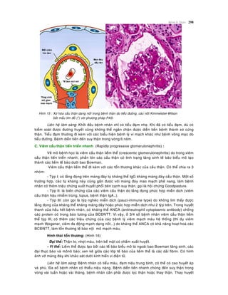 Beänh lyù Thaän 298
Hình 15 : Xô hoùa caàu thaän daïng noát trong beänh thaän do tieåu ñöôøng, caùc noát Kimmelstiel-Wilson
baét maàu tím ñoû (*) vôùi phöông phaùp PAS.
Lieân heä laâm saøng: Khôûi ñaàu beänh nhaân chæ coù tieåu ñaïm nheï. Khi ñaõ coù tieåu ñaïm, duø coù
kieåm soaùt ñöôïc ñöôøng huyeát cuõng khoâng theå ngaên chaën ñöôïc dieãn tieán beänh thaønh xô cöùng
thaän. Tieåu ñaïm thöôøng ñi keøm vôùi caùc bieåu hieän beänh lyù vi maïch khaùc nhö beänh voõng maïc do
tieåu ñöôøng. Beänh dieãn tieán ñeán suy thaän trong voøng 6 naêm.
C. Vieâm caàu thaän tieán trieån nhanh (Rapidly progressive glomerulonephritis) :
Veà moâ beänh hoïc laø vieâm caàu thaän lieàm theå (crescentic glomerulonephritis) do trong vieâm
caàu thaän tieán trieån nhanh, phaàn lôùn caùc caàu thaän coù tình traïng taêng sinh teá baøo bieåu moâ taïo
thaønh caùc lieàm teá baøo döôùi bao Bowman.
Vieâm caàu thaän lieàm theå ñi keøm vôùi caùc toån thöông khaùc cuûa caàu thaän. Coù theå chia ra 3
nhoùm:
- Tyùp I: coù laéng ñoïng treân maøng ñaùy töï khaùng theå IgG khaùng maøng ñaùy caàu thaän. Moät soá
tröôøng hôïp, caùc töï khaùng naøy cuõng gaén ñöôïc vôùi maøng ñaùy mao maïch pheá nang, laøm beänh
nhaân coù theâm trieäu chöùng xuaát huyeát phoåi beân caïnh suy thaän, goïi laø hoäi chöùng Goodpasture.
- Tyùp II: laø bieán chöùng cuûa caùc vieâm caàu thaän do laéng ñoïng phöùc hôïp mieãn dòch (vieâm
caàu thaän haäu nhieãm truøng, lupus, beänh thaän IgA…).
- Tyùp III: coøn goïi laø tyùp ngheøo mieãn dòch (pauci-immune type) do khoâng tìm thaáy ñöôïc
laéng ñoïng cuûa khaùng theå khaùng maøng ñaùy hoaëc phöùc hôïp mieãn dòch nhö 2 tyùp treân. Trong huyeát
thanh cuûa haàu heát beänh nhaân, coù khaùng theå ANCA (antineutrophil cytoplasmic antibody) choáng
caùc protein coù trong baøo töông cuûa BCÑNTT. Vì vaäy, ôû 3/4 soá beänh nhaân vieâm caàu thaän lieàm
theå tyùp III, coù theâm caùc trieäu chöùng cuûa caùc beänh lyù vieâm maïch maùu heä thoáng (thí duï vieâm
maïch Wegener, vieâm ña ñoäng maïch daïng noát...) do khaùng theå ANCA coù khaû naêng hoaït hoaù caùc
BCÑNTT, laøm toån thöông teá baøo noäi moâ maïch maùu.
Hình thaùi toån thöông: (Hình 16)
Ñaïi theå: Thaän to, nhôït maøu, treân beà maët coù chaám xuaát huyeát.
- Vi theå: Lieàm theå ñöôïc taïo bôûi caùc teá baøo bieåu moâ laù ngoaøi bao Bowman taêng sinh, caùc
ñaïi thöïc baøo vaø moânoâ baøo; xen keõ giöõa caùc lôùp teá baøo cuûa lieàm theå laø caùc daûi fibrin. Coù hình
aûnh vôõ maøng ñaùy khi khaûo saùt döôùi kính hieån vi ñieän töû.
Lieân heä laâm saøng: Beänh nhaân coù tieåu maùu, ñaïm nieäu trung bình, coù theå coù cao huyeát aùp
vaø phuø. Ña soá beänh nhaân coù thieåu nieäu naëng. Beänh dieãn tieán nhanh choùng ñeán suy thaän trong
voøng vaøi tuaàn hoaëc vaøi thaùng, beänh nhaân caàn phaûi ñöôïc loïc thaän hoaëc thay thaän. Thay huyeát
 