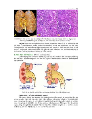 Beänh lyù Thaän 300
Hình 17: Vieâm thaän-beå thaän caáp, beà maët thaän noåi nhieàu oå aùp xe nhoû (muõi teân) (A); Moâ keõ vaø oáng thaän (1)
thaám nhaäp BCÑNTT trong khi caàu thaän vaãn bình thöôøng (B), coù choã taïo aùp xe (1) (C).
- Vi theå: hình aûnh vieâm caáp tính hoaïi töû sinh muû vaø hình thaønh oå aùp xe ôû moät hoaëc hai
nhuù thaän. ÔÛ giai ñoaïn sôùm, nhieãm khuaån coøn giôùi haïn ôû moâ keõ, sau ñoù môùi lan vaøo oáng thaän.
Trong oáng goùp, caùc baïch caàu ña nhaân trung tính taïo neân nhöõng truï baïch caàu ñaëc tröng, coù theå
tìm thaáy khi laøm xeùt nghieäm nöôùc tieåu. Caàu thaän vaø maïch maùu thaän coøn bình thöôøng khoâng bò
toån thöông. Tröôøng hôïp naëng, nhuù thaän coù theå bò hoaïi töû.
B. Vieâm thaän - beå thaän maõn (Chronic pyelonephritis):
Laø tình traïng vieâm kinh nieân moâ keõ gaây hoaù seïo nhu moâ thaän laøm bieán daïng heä thoáng
ñaøi - beå thaän. Beänh thöôøng dieãn tieán daàn ñeán suy thaän maõn moät caùch aâm thaàm. Phaân bieät hai
loaïi: (Hình 18)
Hình 18: Sô ñoà phaân bieät hình aûnh toån thöông cuûa 2 loaïi vieâm thaän- beå thaän maõn
- Vieâm thaän – beå thaän maõn do taéc ngheõn:
Taéc ngheõn ñöôøng tieåu taïo ñieàu kieän thuaän lôïi cho nhieãm khuaån taùi phaùt nhieàu laàn, gaây
xô hoaù vaø vieâm thaän – beå thaän maõn. Vieâm thaän - beå thaän maõn coù theå chæ xaûy ra ôû moät beân thaän
trong tröôøng hôïp taéc ngheõn do soûi, hoaëc chít heïp baát thöôøng moät nieäu quaûn; hoaëc ôû caû hai thaän
trong tröôøng hôïp coù dò taät baåm sinh ôû nieäu ñaïo (van nieäu ñaïo sau,…). Taéc ngheõn laøm taêng aùp löïc
ngöôïc doøng, laøm giaõn taát caû caùc ñaøi thaän, beå thaän. Nhu moâ thaän vuøng tuyû vaø voû bò nhieãm khuaån
taùi ñi taùi laïi, laøm nhuù thaän bò huyû vaø hoaù seïo voû thaän beân treân.
 