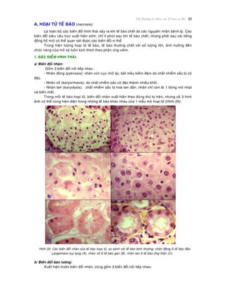 Toån Thöông Cô Baûn cuûa Teá baøo vaø Moâ 23
A. HOAÏI TÖÛ TEÁ BAØO (necrosis):
Laø toaøn boä caùc bieán ñoåi hình thaùi xaûy ra khi teá baøo cheát do caùc nguyeân nhaân beänh lyù. Caùc
bieán ñoåi sieâu caáu truùc xuaát hieän sôùm, chæ ít phuùt sau khi teá baøo cheát; nhöng phaûi sau vaøi tieáng
ñoàng hoà môùi coù theå quan saùt ñöôïc caùc bieán ñoåi vi theå.
Trong hieän töôïng hoaïi töû teá baøo, teá baøo thöôøng cheát vôùi soá löôïng lôùn, aûnh höôûng ñeán
chöùc naêng cuûa moâ vaø luoân kích thích theo phaûn öùng vieâm.
1. ÑAËC ÑIEÅM HÌNH THAÙI:
a/ Bieán ñoåi nhaân:
Goàm 3 bieán ñoåi noái tieáp nhau :
- Nhaân ñoâng (pyknosis): nhaân voùn cuïc nhoû laïi, baét maàu kieàm ñaäm do chaát nhieãm saéc bò coâ
ñaëc.
- Nhaân vôõ (karyorrhexis): do chaát nhieãm saéc coâ ñaëc thaønh nhieàu khoái .
- Nhaân tan (karyolysis): chaát nhieãm saéc bò hoaø tan daàn, nhaân chæ coøn laø 1 boùng môø nhaït
vaø bieán maát .
Trong moãi teá baøo hoaïi töû, bieán ñoåi nhaân xuaát hieän theo ñuùng thöù töï treân, nhöng caû 3 hình
aûnh coù theå cuøng hieän dieän trong nhöõng teá baøo khaùc nhau cuûa 1 maãu moâ hoaïi töû (Hình 20).
Hình 20: Caùc bieán ñoåi nhaân cuûa teá baøo hoaïi töû, so saùnh vôùi teá baøo bình thöôøng: nhaân ñoâng ôû teá baøo ñaûo
Langerhans tuïy taïng (A), nhaân vôõ ôû teá baøo gan (B), nhaân tan ôû teá baøo oáng thaän (C).
b/ Bieán ñoåi baøo töông:
Xuaát hieän tröôùc bieán ñoåi nhaân, cuõng goàm 3 bieán ñoåi noái tieáp nhau:
 