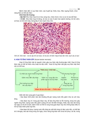 Beänh lyù Thaän 302
Beänh nhaân ñeán vì suy thaän maõn, cao huyeát aùp, thieáu maùu. Neáu ngöng thuoác, chöùc
naêng thaän coù theå caûi thieän.
Hình thaùi toån thöông:
- Ñaïi theå: Nhuù thaän hoaïi töû coù maøu vaøng naâu, nhaên nhuùm, troùc ra vaø rôi vaøo beå thaän.
- Vi theå: Nhuù thaän hoaïi töû ñoâng, raûi raùc coù caùc oå calci hoaù nghòch döôõng; moâ keõ vieâm,
xô hoaù; coù hình aûnh daøy maøng ñaùy ôû caùc maïch maùu nhoû.
Hình 20: Vieâm thaän - moâ keõ caáp tính do thuoác, moâ keõ phuø neà thaám nhaäp teá baøo ñôn nhaân, baïch caàu aùi toan
II. HOAÏI TÖÛ OÁNG THAÄN CAÁP (Acute tubular necrosis):
Hoaïi töû oáng thaän caáp laø nguyeân nhaân gaây suy thaän caáp thöôøng gaëp nhaát. Hoaïi töû oáng
thaän caáp coù theå do thieáu maùu hoaëc do ñoäc chaát. Hoaïi töû oáng thaän caáp gaây suy thaän caáp theo
caùc cô cheá sau:
Dieãn tieán laâm saøng goàm 3 giai ñoaïn:
- Giai ñoaïn khôûi phaùt: keùo daøi khoaûng 36 giôø, löôïng nöôùc tieåu giaûm nheï vaø ureâ maùu
taêng.
- Giai ñoaïn duy trì: trong giai ñoaïn naøy, teá baøo oáng thaän bò toån thöông, bong troùc gaây
ngheõn oáng thaän, löôïng nöôùc tieåu giaûm xuoáng chæ coøn 50-400 ml/ngaøy, thieåu nieäu keùo daøi trong
vaøi ngaøy coù khi tôùi 3 tuaàn, beänh nhaân coù theå töû vong trong giai ñoaïn naøy neáu khoâng ñöôïc ñieàu trò
hoã trôï hoaëc thaåm phaân kòp thôøi.
- Giai ñoaïn hoài phuïc: löôïng nöôùc tieåu taêng do maát khaû naêng coâ ñaëc nöôùc tieåu, coù theå ñaït
tôùi 3 lít/ngaøy, keùo daøi trong voøng vaøi ngaøy, chöùc naêng oáng thaän vaãn chöa hoài phuïc, do ñoù, trong
 