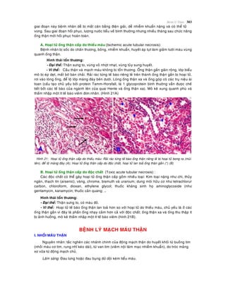 Beänh lyù Thaän 303
giai ñoaïn naøy beänh nhaân deã bò maát caân baèng ñieän giaûi, deã nhieãm khuaån naëng vaø coù theå töû
vong. Sau giai ñoaïn hoài phuïc, löôïng nöôùc tieåu veà bình thöôøng nhöng nhieàu thaùng sau chöùc naêng
oáng thaän môùi hoài phuïc hoaøn toaøn.
A. Hoaïi töû oáng thaän caáp do thieáu maùu (Ischemic acute tubular necrosis):
Beänh nhaân bò soác do chaán thöông, boûng, nhieãm khuaån, huyeát aùp tuït laøm giaûm töôùi maùu vuøng
quanh oáng thaän.
Hình thaùi toån thöông:
- Ñaïi theå: Thaän söng to, vuøng voû nhôït nhaït, vuøng tuûy sung huyeát.
- Vi theå: Caàu thaän vaø maïch maùu khoâng bò toån thöông. OÁng thaän gaàn giaõn roäng, lôùp bieåu
moâ bò eùp deït, maát bôø baøn chaûi. Raûi raùc töøng teá baøo rieâng leû treân thaønh oáng thaän gaàn bò hoaïi töû,
rôi vaøo loøng oáng, ñeå loä lôùp maøng ñaùy beân döôùi. Loøng oáng thaän xa vaø oáng goùp coù caùc truï nieäu aùi
toan (caáu taïo chuû yeáu bôûi protein Tamm-Horsfall, laø 1 glycoprotein bình thöôøng vaãn ñöôïc cheá
tieát bôûi caùc teá baøo cuûa ngaønh leân cuûa quai Henle vaø oáng thaän xa). Moâ keõ xung quanh phuø vaø
thaám nhaäp moät ít teá baøo vieâm ñôn nhaân. (Hình 21A)
Hình 21: Hoaïi töû oáng thaän caáp do thieáu maùu: Raûi raùc töøng teá baøo oáng thaän rieâng leû bò hoaïi töû bong ra (muõi
teân), ñeå loä maøng ñaùy (A); Hoaïi töû oáng thaän caáp do ñoäc chaát, hoaïi töû lan toaû oáng thaän gaàn (*) (B)
B. Hoaïi töû oáng thaän caáp do ñoäc chaát (Toxic acute tubular necrosis) :
Caùc ñoäc chaát coù theå gaây hoaïi töû oáng thaän caáp goàm nhieàu loaïi: Kim loaïi naëng nhö chì, thuûy
ngaân, thaïch tín (arsenic), vaøng, chrome, bismuth vaø uranium; dung moâi höõu cô nhö tetrachlorur
carbon, chloroform, dioxan, ethylene glycol; thuoác khaùng sinh hoï aminoglycoside (nhö
gentamycin, kanamycin; thuoác caûn quang; …
Hình thaùi toån thöông:
- Ñaïi theå: Thaän söng to, coù maøu ñoû.
- Vi theå: Hoaïi töû teá baøo oáng thaän lan toaû hôn so vôùi hoaïi töû do thieáu maùu, chuû yeáu laø ôû caùc
oáng thaän gaàn vì ñaây laø phaàn oáng nhaïy caûm hôn caû vôùi ñoäc chaát; oáng thaän xa vaø oáng thu thaäp ít
bò aûnh höôûng, moâ keõ thaám nhaäp moät ít teá baøo vieâm (hình 21B).
BEÄNH LYÙ MAÏCH MAÙU THAÄN
I. NHOÀI MAÙU THAÄN
Nguyeân nhaân: taéc ngheõn caùc nhaùnh chính cuûa ñoäng maïch thaän do huyeát khoái töø buoàng tim
(nhoài maùu cô tim, rung nhó keùo daøi), töø van tim (vieâm noäi taâm maïc nhieãm khuaån), do troùc maûng
xô vöõa töø ñoäng maïch chuû.
Laâm saøng: Ñau löng hoaëc ñau buïng döõ doäi keøm tieåu maùu.
 