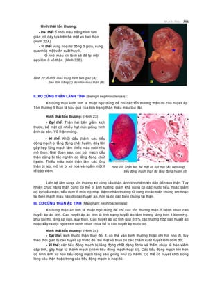 Beänh lyù Thaän 304
Hình thaùi toån thöông:
- Ñaïi theå: oå nhoài maùu traéng hình tam
giaùc, coù ñaùy töïa treân beà maët voû bao thaän.
(Hình 22A)
- Vi theå: vuøng hoaïi töû ñoâng ôû giöõa, xung
quanh laø moät vieàn xuaát huyeát.
OÅ nhoài maùu khi laønh seõ ñeå laïi moät
seïo loõm ôû voû thaän. (Hình 22B)
Hình 22: oå nhoài maùu traéng hình tam giaùc (A);
Seïo loõm traéng (*) do nhoài maùu thaän (B).
II. XÔ CÖÙNG THAÄN LAØNH TÍNH (Benign nephrosclerosis):
Xô cöùng thaän laønh tính laø thuaät ngöõ duøng ñeå chæ caùc toån thöông thaän do cao huyeát aùp.
Toån thöông ôû thaän laø haäu quaû cuûa tình traïng thaän thieáu maùu laâu daøi.
Hình thaùi toån thöông: (Hình 23)
- Ñaïi theå: Thaän hai beân giaûm kích
thöôùc, beà maët coù nhieàu haït mòn gioáng hình
aûnh da saàn. Voû thaän moûng.
- Vi theå: Khôûi ñaàu thaønh caùc tieåu
ñoäng maïch bò laéng ñoïng chaát hyalin, daày leân
gaây heïp loøng maïch laøm thieáu maùu nuoâi nhu
moâ thaän. Giai ñoaïn sau, caùc buùi maïch caàu
thaän cuõng bò taéc ngheõn do laéng ñoïng chaát
hyalin. Thieáu maùu nuoâi thaän laøm caùc oáng
thaän bò teo, moâ keõ bò xô hoaù vaø ngaám moät ít
teá baøo vieâm.
Hình 23: Thaän teo, beà maët coù haït mòn (A); heïp loøng
tieåu ñoäng maïch thaän do laéng ñoïng hyalin (B)
Lieân heä laâm saøng: toån thöông xô cöùng caàu thaän laønh tính hieám khi daãn ñeán suy thaän. Tuy
nhieân chöùc naêng thaän cuõng coù theå bò aûnh höôûng: giaûm khaû naêng coâ ñaëc nöôùc tieåu, hoaëc giaûm
ñoä loïc caàu thaän, tieåu ñaïm ôû möùc ñoä nheï. Beänh nhaân thöôøng töû vong vì caùc bieán chöùng tim hoaëc
tai bieán maïch maùu naõo do cao huyeát aùp, hôn laø do caùc bieán chöùng taïi thaän.
III. XÔ CÖÙNG THAÄN AÙC TÍNH (Malignant nephrosclerosis):
Xô cöùng thaän aùc tính laø thuaät ngöõ duøng ñeå chæ caùc toån thöông thaän ôû beänh nhaân cao
huyeát aùp aùc tính. Cao huyeát aùp aùc tính laø tình traïng huyeát aùp taâm tröông taêng treân 130mmHg,
phuø gai thò, taêng aùp naõo, suy thaän. Cao huyeát aùp aùc tính gaëp ôû 5% caùc tröôøng hôïp cao huyeát aùp
hoaëc xaûy ra ñoät ngoät treân beänh nhaân chöa heà bò cao huyeát aùp tröôùc ñoù.
Hình thaùi toån thöông: (Hình 24)
- Ñaïi theå: kích thöôùc thaän thay ñoåi ít, coù theå vaãn bình thöôøng hoaëc chæ hôi nhoû ñi, tuøy
theo thôøi gian bò cao huyeát aùp tröôùc ñoù. Beà maët voû thaän coù caùc chaám xuaát huyeát loám ñoám ñoû.
- Vi theå: caùc tieåu ñoäng maïch bò laéng ñoïng chaát daïng fibrin vaø thaám nhaäp teá baøo vieâm
caáp tính, gaây hoaïi töû thaønh maïch (vieâm tieåu ñoäng maïch hoaïi töû). Caùc tieåu ñoäng maïch lôùn hôn
coù hình aûnh xô hoaù tieåu ñoäng maïch taêng saûn gioáng nhö cuû haønh. Coù theå coù huyeát khoái trong
loøng caàu thaän hoaëc trong caùc tieåu ñoäng maïch bò hoaïi töû.
 