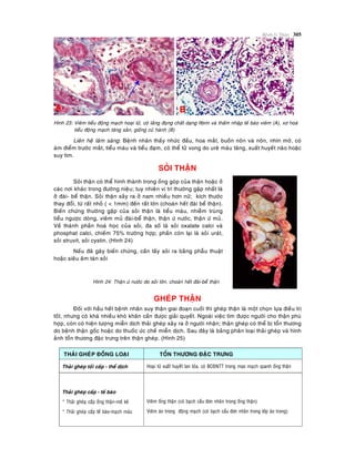 Beänh lyù Thaän 305
Hình 23: Vieâm tieåu ñoäng maïch hoaïi töû, coù laéng ñoïng chaát daïng fibrin vaø thaám nhaäp teá baøo vieâm (A), xô hoaù
tieåu ñoäng maïch taêng saûn, gioáng cuû haønh (B)
Lieân heä laâm saøng: Beänh nhaân thaáy nhöùc ñaàu, hoa maét, buoàn noân vaø noân, nhìn môø, coù
aùm ñieåm tröôùc maét, tieåu maùu vaø tieåu ñaïm, coù theå töû vong do ureâ maùu taêng, xuaát huyeát naõo hoaëc
suy tim.
SOÛI THAÄN
Soûi thaän coù theå hình thaønh trong oáng goùp cuûa thaän hoaëc ôû
caùc nôi khaùc trong ñöôøng nieäu; tuy nhieân vò trí thöôøng gaëp nhaát laø
ôû ñaøi- beå thaän. Soûi thaän xaûy ra ôû nam nhieàu hôn nöõ; kích thöôùc
thay ñoåi, töø raát nhoû ( < 1mm) ñeán raát lôùn (choaùn heát ñaøi beå thaän).
Bieán chöùng thöôøng gaëp cuûa soûi thaän laø tieåu maùu, nhieãm truøng
tieåu ngöôïc doøng, vieâm muû ñaøi-beå thaän, thaän öù nöôùc, thaän öù muû.
Veà thaønh phaàn hoaù hoïc cuûa soûi, ña soá laø soûi oxalate calci vaø
phosphat calci, chieám 75% tröôøng hôïp; phaàn coøn laïi laø soûi uraùt,
soûi struvit, soûi cystin. (Hình 24)
Neáu ñaõ gaây bieán chöùng, caàn laáy soûi ra baèng phaãu thuaät
hoaëc sieâu aâm taùn soûi
Hình 24: Thaän öù nöôùc do soûi lôùn, choaùn heát ñaøi-beå thaän
GHEÙP THAÄN
Ñoái vôùi haàu heát beänh nhaân suy thaän giai ñoaïn cuoái thì gheùp thaän laø moät choïn löïa ñieàu trò
toát, nhöng coù khaù nhieàu khoù khaên caàn ñöôïc giaûi quyeát. Ngoaøi vieäc tìm ñöôïc ngöôøi cho thaän phuø
hôïp, coøn coù hieän töôïng mieãn dòch thaûi gheùp xaûy ra ôû ngöôøi nhaän; thaän gheùp coù theå bò toån thöông
do beänh thaän goác hoaëc do thuoác öùc cheá mieãn dòch. Sau ñaây laø baûng phaân loaïi thaûi gheùp vaø hình
aûnh toån thöông ñaëc tröng treân thaän gheùp. (Hình 25)
THAÛI GHEÙP ÑOÀNG LOAÏI TOÅN THÖÔNG ÑAËC TRÖNG
Thaûi gheùp toái caáp - theå dòch Hoaïi töû xuaát huyeát lan toûa, coù BCÑNTT trong mao maïch quanh oáng thaän
Thaûi gheùp caáp - teá baøo
* Thaûi gheùp caáp oáng thaän-moâ keõ
* Thaûi gheùp caáp teá baøo-maïch maùu
Vieâm oáng thaän (coù baïch caàu ñôn nhaân trong oáng thaän)
Vieâm aùo trong ñoäng maïch (coù baïch caàu ñôn nhaân trong lôùp aùo trong)
 