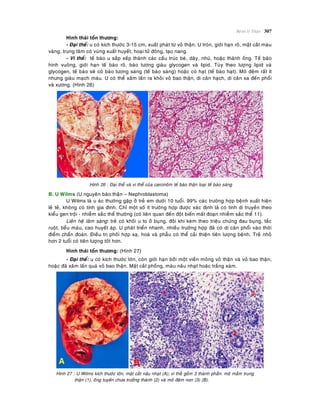 Beänh lyù Thaän 307
Hình thaùi toån thöông:
- Ñaïi theå: u coù kích thöôùc 3-15 cm, xuaát phaùt töø voû thaän. U troøn, giôùi haïn roõ, maët caét maøu
vaøng, trung taâm coù vuøng xuaát huyeát, hoaïi töû ñoâng, taïo nang.
- Vi theå: teá baøo u saép xeáp thaønh caùc caáu truùc beø, daây, nhuù, hoaëc thaønh oáng. Teá baøo
hình vuoâng, giôùi haïn teá baøo roõ, baøo töông giaøu glycogen vaø lipid. Tuøy theo löôïng lipid vaø
glycogen, teá baøo seõ coù baøo töông saùng (teá baøo saùng) hoaëc coù haït (teá baøo haït). Moâ ñeäm raát ít
nhöng giaøu maïch maùu. U coù theå xaâm laán ra khoûi voû bao thaän, di caên haïch, di caên xa ñeán phoåi
vaø xöông. (Hình 26)
Hình 26 : Ñaïi theå vaø vi theå cuûa carcinoâm teá baøo thaän loaïi teá baøo saùng
B. U Wilms (U nguyeân baøo thaän – Nephroblastoma)
U Wilms laø u aùc thöôøng gaëp ôû treû em döôùi 10 tuoåi. 99% caùc tröôøng hôïp beänh xuaát hieän
leû teû, khoâng coù tính gia ñình. Chæ moät soá ít tröôøng hôïp ñöôïc xaùc ñònh laø coù tính di truyeàn theo
kieåu gen troäi - nhieãm saéc theå thöôøng (coù lieân quan ñeán ñoät bieán maát ñoaïn nhieãm saéc theå 11).
Lieân heä laâm saøng: treû coù khoái u to ôû buïng, ñoâi khi keøm theo trieäu chöùng ñau buïng, taéc
ruoät, tieåu maùu, cao huyeát aùp. U phaùt trieån nhanh, nhieàu tröôøng hôïp ñaõ coù di caên phoåi vaøo thôøi
ñieåm chaån ñoaùn. Ñieàu trò phoái hôïp xaï, hoaù vaø phaãu coù theå caûi thieän tieân löôïng beänh. Treû nhoû
hôn 2 tuoåi coù tieân löôïng toát hôn.
Hình thaùi toån thöông: (Hình 27)
- Ñaïi theå: u coù kích thöôùc lôùn, coøn giôùi haïn bôûi moät vieàn moûng voû thaän vaø voû bao thaän,
hoaëc ñaõ xaâm laán quaù voû bao thaän. Maët caét phoàng, maøu naâu nhaït hoaëc traéng xaùm.
Hình 27 : U Wilms kích thöôùc lôùn, maët caét naâu nhaït (A); vi theã goàm 3 thaønh phaàn. moâ maàm trung
thaän (1), oáng tuyeán chöa tröôûng thaønh (2) vaø moâ ñeäm non (3) (B).
 