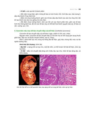 Beänh lyù Thaän 308
- Vi theå: u caáu taïo bôûi 3 thaønh phaàn:
+ Moâ maàm trung thaän: goàm nhöõng teá baøo coù kích thöôùc nhoû, hình baàu duïc, baøo töông ít,
saép xeáp thaønh oå hay thaønh beø.
+ Bieåu moâ chöa tröôûng thaønh: goàm caùc teá baøo saép xeáp thaønh caùc caáu truùc oáng nhoû, ñoâi
khi taïo thaønh caùc caáu truùc gioáng nhö caàu thaän.
+ Moâ ñeäm chöa tröôûng thaønh: naèm xen laãn vôùi caùc thaønh phaàn treân, goàm caùc teá baøo
hình thoi khoâng bieät hoaù, ñoâi khi caùc teá baøo naøy coù theå bieät hoaù thaønh nguyeân baøo sôïi, teá baøo cô
vaân, xöông, suïn, môõ.
C. Carcinoâm nieäu maïc (teá baøo chuyeån tieáp) cuûa beå thaän (Urothelial carcinoma):
Carcinoâm teá baøo chuyeån tieáp cuûa beå thaän ít gaëp, chieám 5-10% caùc u thaän.
Nguyeân nhaân: carcinoâm teá baøo chuyeån tieáp coù moái lieân heä vôùi tình traïng laïm duïng thuoác
giaûm ñau, tieáp xuùc vôùi thuoác nhuoäm aniline, cao su, nhöïa,…
Khoái u phaùt trieån taïo nhuù trong heä thoáng ñaøi beå thaän, gaây trieäu chöùng tieåu maùu vaø taéc
ngheõn ñöôøng nieäu.
Hình thaùi toån thöông: (Hình 28)
- Ñaïi theå: u daïng choài suøi taïo nhuù, maät ñoä meàm, coù theå choaùn heát ñaøi-beå thaän, cheøn eùp
tuyû thaän.
- Vi theå: bieåu moâ chuyeån tieáp taêng sinh nhieàu lôùp, taïo nhuù; nhaân teá baøo taêng saéc, coù
theå dò daïng.
Hình 28: Ñaïi theå vaø vi theå carcinoâm nieäu maïc daïng choài suøi trong beå thaän, cheøn eùp tuyû thaän.
 