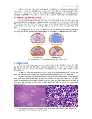 Beänh lyù haïch limphoâ 316
- Moät taùc nhaân gaây vieâm haït thöôøng gaëp laø vi khuaån lao (mycobacterium tuberculosis).
Haïch söng to, 1 phaàn hay toaøn boä nhu moâ haïch bò xaâm chieám bôûi caùc nang lao. Nang lao ñöôïc
taïo thaønh töø moät hay nhieàu u haït lao, caáu taïo bôûi caùc teá baøo daïng bieåu moâ, ñaïi baøo Langhans,
töông baøo, limphoâ baøo, ôû trung taâm coù hoaïi töû baõ ñaäu (xem hình 27, chöông vieâm vaø söûa chöõa).
IV. HAÏCH TAÊNG SAÛN PHAÛN ÖÙNG
Haïch taêng kích thöôùc do taêng saûn moät hoaëc nhieàu thaønh phaàn teá baøo cuûa haïch, phaûn öùng
laïi vôùi caùc kích thích khaùng nguyeân. Ñaây laø moät toån thöông laønh tính vaø coù tính khaû hoài (Hình 6).
Raát nhieàu taùc nhaân kích thích haïch taêng saûn phaûn öùng (vi truøng, viruùt, hoaù chaát, moâi tröôøng oâ
nhieãm, thuoác, v.v.). Haïch söng to (thöôøng < 1,5cm), maät ñoä meàm hoaëc chaéc, giôùi haïn roõ, di
ñoäng.
Tuøy khaùng nguyeân coù khaû naêng kích thích gaây ñaùp öùng mieãn dòch dòch theå hay mieãn dòch
qua trung gian teá baøo, hình aûnh taêng saûn cuûa haïch seõ khaùc nhau. Coù 4 hình thaùi moâ hoïc chính:
Hình 6: Sô ñoà caùc hình thaùi taêng saûn phaûn öùng laønh tính cuûa haïch.
A. TAÊNG SAÛN NANG
- Taêng saûn nang thöôøng gaëp trong caùc nhieãm truøng maõn tính do caùc taùc nhaân kích thích
gaây ñaùp öùng mieãn dòch dòch theå. Moät soá nguyeân nhaân coù theå keå ñeán goàm: vieâm khôùp daïng thaáp,
giai ñoaïn sôùm cuûa nhieãm HIV (human immunodeficiency virus), vieâm amiñan, nhieãm
toxoplasma, v.v.
- Vi theå: caùc trung taâm maàm taêng saûn, giaõn roäng, chöùa caùc teá baøo limphoâ B ôû nhöõng giai
ñoaïn bieät hoaù khaùc nhau. Vuøng quanh nang thaám nhaäp töông baøo, nguyeân baøo mieãn dòch.
Caàn phaân bieät hình aûnh taêng saûn nang vôùi hình aûnh nang cuûa limphoâm khoâng Hodgkin
daïng nang. Nang limphoâ taêng saûn: (1) haïch vaãn baûo toàn caáu truùc bình thöôøng; (2) caùc nang
limphoâ coù kích thöôùc vaø hình daïng raát khaùc nhau; (3) trung taâm maàm phaân cöïc roõ, ña daïng teá
baøo, nhieàu ñaïi thöïc baøo vaø phaân baøo; (4) vieàn quanh taâm maàm laø caùc teá baøo limphoâ bình
thöôøng. (Hình 7)
Hình 7: Haïch taêng saûn nang, caùc nang limphoâ kích thöôùc vaø hình daïng khoâng ñeàu (A); Trung taâm maàm ña
daïng teá baøo, nhieàu ñaïi thöïc baøo vaø phaân baøo (B).
 
