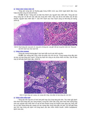 Beänh lyù haïch limphoâ 317
B. TAÊNG SAÛN VUØNG CAÄN VOÛ
- Taêng saûn vuøng caän voû thöôøng gaëp trong nhieãm viruùt, sau chích ngöøa beänh ñaäu muøa,
hoaëc do phaûn öùng vôùi moät soá thuoác.
- Vi theå: teá baøo T taêng sinh vaø bieät hoùa thaønh caùc nguyeân baøo mieãn dòch. Taêng saûn lan
roäng vuøng caän voû ñoâi khi xoaù maát caùc trung taâm maàm, thay vaøo ñoù laø raát nhieàu caùc teá baøo
limphoâ, nguyeân baøo mieãn dòch T. Caùc tónh maïch sau mao maïch cuõng coù theå taêng soá löôïng.
(Hình 8)
Hình 8: Haïch taêng saûn vuøng caän voû, vuøng caän voû taêng saûn, xoaù gaàn heát caùc trung taâm maàm (A); Taêng saûn
caùc tónh maïch sau mao maïch (B).
C. TAÊNG SAÛN XOANG
- Taêng saûn xoang thöôøng gaëp ôû caùc haïch daãn löu töø caùc khoái ung thö.
- Vi theå: Caùc xoang daõn roäng, cheøn eùp phaàn nhu moâ coøn laïi. Trong xoang chöùa ñaày dòch
vaø caùc moâ baøo taêng sinh maïnh. Vuøng tuûy haïch lôùn roäng ra do chöùa nhieàu moâ baøo. Caùc teá baøo
naøy coù theå xeáp thaønh ñaùm ñaëc. (Hình 9)
Hình 9: Haïch taêng saøn xoang, caùc xoang daõn roäng, chöùa ñaày moâ baøo taêng saûn (muõi teân).
D. TAÊNG SAÛN HOÃN HÔÏP
- Taêng saûn hoãn hôïp khi coù hình aûnh phoái hôïp cuûa 3 loaïi taêng saûn treân. Taùc nhaân gaây beänh
kích thích haïch taêng saûn caùc nang limphoâ, trung taâm maàm daõn roäng, keøm theo hieän töôïng taêng
sinh caùc nguyeân baøo mieãn dòch vaø caùc teá baøo limphoâ trong moâ limphoâ chen giöõa caùc nang, ñoâi
khi coù hieän töôïng taêng saûn xoang vôùi caùc xoang daõn roäng chöùa ñaày moâ baøo. Coù theå gaëp taêng
saûn hoãn hôïp trong caùc beänh nhö taêng baïch caàu ñôn nhaân nhieãm khuaån, nhieãm toxoplasma,
beänh meøo caøo.
 