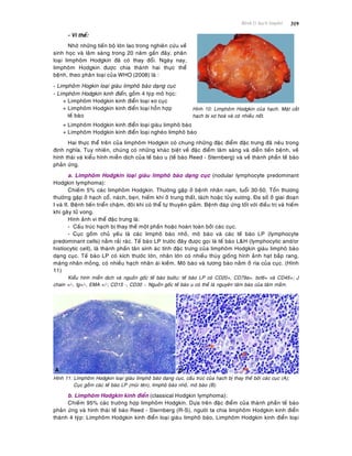 Beänh lyù haïch limphoâ 319
- Vi theå:
Nhôø nhöõng tieán boä lôùn lao trong nghieân cöùu veà
sinh hoïc vaø laâm saøng trong 20 naêm gaàn ñaây, phaân
loaïi limphoâm Hodgkin ñaõ coù thay ñoåi. Ngaøy nay,
limphoâm Hodgkin ñöôïc chia thaønh hai thöïc theå
beänh, theo phaân loaïi cuûa WHO (2008) laø :
- Limphoâm Hogkin loaïi giaøu limphoâ baøo daïng cuïc
- Limphoâm Hodgkin kinh ñieån, goàm 4 tyùp moâ hoïc:
+ Limphoâm Hodgkin kinh ñieån loaïi xô cuïc
+ Limphoâm Hodgkin kinh ñieån loaïi hoãn hôïp
teá baøo
Hình 10: Limphoâm Hodgkin cuûa haïch. Maët caét
haïch bò xô hoaù vaø coù nhieàu noát.
+ Limphoâm Hodgkin kinh ñieån loaïi giaøu limphoâ baøo
+ Limphoâm Hodgkin kinh ñieån loaïi ngheøo limphoâ baøo
Hai thöïc theå treân cuûa limphoâm Hodgkin coù chung nhöõng ñaëc ñieåm ñaëc tröng ñaõ neâu trong
ñònh nghóa. Tuy nhieân, chuùng coù nhöõng khaùc bieät veà ñaëc ñieåm laâm saøng vaø dieãn tieán beänh, veà
hình thaùi vaø kieåu hình mieãn dòch cuûa teá baøo u (teá baøo Reed - Sternberg) vaø veà thaønh phaàn teá baøo
phaûn öùng.
a. Limphoâm Hodgkin loaïi giaøu limphoâ baøo daïng cuïc (nodular lymphocyte predominant
Hodgkin lymphoma):
Chieám 5% caùc limphoâm Hodgkin. Thöôøng gaëp ôû beänh nhaân nam, tuoåi 30-50. Toån thöông
thöôøng gaëp ôû haïch coå, naùch, beïn, hieám khi ôû trung thaát, laùch hoaëc tuûy xöông. Ña soá ôû giai ñoaïn
I vaø II. Beänh tieán trieån chaäm, ñoâi khi coù theå töï thuyeân giaûm. Beänh ñaùp öùng toát vôùi ñieàu trò vaø hieám
khi gaây töû vong.
Hình aûnh vi theå ñaëc tröng laø:
- Caáu truùc haïch bò thay theá moät phaàn hoaëc hoaøn toaøn bôûi caùc cuïc.
- Cuïc goàm chuû yeáu laø caùc limphoâ baøo nhoû, moâ baøo vaø caùc teá baøo LP (lymphocyte
predominant cells) naèm raûi raùc. Teá baøo LP tröôùc ñaây ñöôïc goïi laø teá baøo L&H (lymphocytic and/or
histiocytic cell), laø thaønh phaàn taân sinh aùc tính ñaëc tröng cuûa limphoâm Hodgkin giaøu limphoâ baøo
daïng cuïc. Teá baøo LP coù kích thöôùc lôùn, nhaân lôùn coù nhieàu thuøy gioáng hình aûnh haït baép rang,
maøng nhaân moûng, coù nhieàu haïch nhaân aùi kieàm. Moâ baøo vaø töông baøo naèm ôû rìa cuûa cuïc. (Hình
11)
Kieåu hình mieãn dòch vaø nguoàn goác teá baøo böôùu: teá baøo LP coù CD20+, CD79a+, bcl6+ vaø CD45+; J
chain +/-, Ig+/-, EMA +/-; CD15 -, CD30 -. Nguoàn goác teá baøo u coù theå laø nguyeân taâm baøo cuûa taâm maàm.
Hình 11: Limphoâm Hodgkin loaïi giaøu limphoâ baøo daïng cuïc, caáu truùc cuûa haïch bò thay theá bôûi caùc cuïc (A);
Cuïc goàm caùc teá baøo LP (muõi teân), limphoâ baøo nhoû, moâ baøo (B).
b. Limphoâm Hodgkin kinh ñieån (classical Hodgkin lymphoma):
Chieám 95% caùc tröôøng hôïp limphoâm Hodgkin. Döïa treân ñaëc ñieåm cuûa thaønh phaàn teá baøo
phaûn öùng vaø hình thaùi teá baøo Reed - Sternberg (R-S), ngöôøi ta chia limphoâm Hodgkin kinh ñieån
thaønh 4 tyùp: Limphoâm Hodgkin kinh ñieån loaïi giaøu limphoâ baøo, Limphoâm Hodgkin kinh ñieån loaïi
 