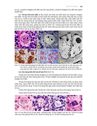 Beänh lyù haïch limphoâ 320
xô cuïc, Limphoâm Hodgkin kinh ñieån loaïi hoãn hôïp teá baøo, Limphoâm Hodgkin kinh ñieån loaïi ngheøo
limphoâ baøo.
b.1. Teá baøo R-S kinh ñieån laø tieâu chuaån caàn thieát cho chaån ñoaùn caùc limphoâm Hodgkin
kinh ñieån. Teá baøo R-S kinh ñieån coù kích thöôùc lôùn (20-50m), baøo töông nhieàu baét maøu aùi toan
nheï vaø coù ít nhaát 2 thuøy nhaân hoaëc 2 nhaân. Nhaân saùng, maøng nhaân daøy, chaát nhieãm saéc thoâ
naèm raûi raùc nhöng chöøa laïi moät khoaûng saùng quanh haïch nhaân. Haïch nhaân lôùn, troøn, aùi toan,
naèm chính giöõa nhaân. Hình aûnh ñieån hình nhaát laø teá baøo R-S kinh ñieån coù 2 nhaân hoaëc 2 thuøy
nhaân naèm ñoái xöùng nhau, gioáng nhö maét cuù (Hình 12). Tröôøng hôïp teá baøo R-S kinh ñieån coù
nhieàu thuøy nhaân coù theå troâng gioáng teá baøo LP; phaân bieät döïa vaøo haïch nhaân, haïch nhaân cuûa teá
baøo R-S thì to hôn vaø aùi toan. (Hình 13)
Hình 12: Teá baøo Reed-Sternberg kinh ñieån ñieån hình coù nhaân hai thuøy, haïch nhaân ñoû, roõ, ñoái xöùng nhau nhö
hình maét cuù, nhuoäm HE (A), laùt caét baùn sieâu moûng, nhuoäm xanh toluidin (B), laùt caét sieâu moûng,
chuïp döôùi kính hieån vi ñieän töû (C), Nhuoäm hoaù moâ mieãn dòch, döông tính vôùi CD15 (D) vaø CD30 (E).
b.2. Caùc daïng bieán theå cuûa teá baøo R-S (Hình 13)
Teá baøo R-S moät nhaân (teá baøo Hodgkin) coù hình thaùi gioáng nhö teá baøo R-S kinh ñieån, nhöng
chæ coù moät nhaân do nhaân khoâng phaân thuøy. Teá baøo Hodgkin coù trong taát caû caùc tyùp cuûa limphoâm
Hodgkin kinh ñieån.
Teá baøo R-S daïng hoác (lacunar cell): teá baøo lôùn (40-50m), baøo töông nhieàu vaø saùng, nhaân
nhieàu thuøy, haïch nhaân nhoû. Do coá ñònh baèng formol, baøo töông bò co laïi, taïo hình aûnh teá baøo
naèm trong moät hoác saùng. Teá baøo R-S daïng hoác gaëp nhieàu trong limphoâm Hodgkin kinh ñieån loaïi
xô cuïc.
Teá baøo R-S daïng thoaùi saûn: teá baøo lôùn; nhaân taêng saéc, ña thuøy raát dò daïng; haïch nhaân to.
Thaønh phaàn teá baøo R-S vaø caùc bieán theå chieám khoâng quaù 10% theå tích u.
Hình 13: Caùc bieán theå cuûa teá baøo Reed - Sternberg (RS): Teá baøo Hodgkin (muõi teân) (A), Teá baøo R-S daïng
nhieàu thuøy nhaân gioáng teá baøo LP (B), Teá baøo R-S daïng hoác (C) Teá baøo R-S daïng thoaùi saûn (D).
 