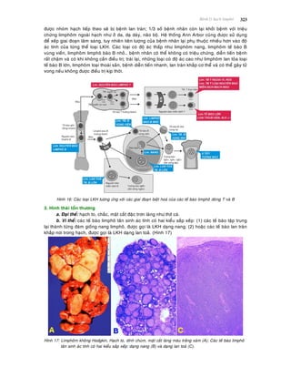 Beänh lyù haïch limphoâ 323
ñöôïc nhoùm haïch tieáp theo seõ bò beänh lan traøn; 1/3 soá beänh nhaân coøn laïi khôûi beänh vôùi trieäu
chöùng limphoâm ngoaøi haïch nhö ôû da, daï daøy, naõo boä. Heä thoáng Ann Arbor cuõng ñöôïc söû duïng
ñeå xeáp giai ñoaïn laâm saøng, tuy nhieân tieân löôïng cuûa beänh nhaân laïi phuï thuoäc nhieàu hôn vaøo ñoä
aùc tính cuûa töøng theå loaïi LKH. Caùc loaïi coù ñoä aùc thaáp nhö limphoâm nang, limphoâm teá baøo B
vuøng vieàn, limphoâm limphoâ baøo B nhoû… beänh nhaân coù theå khoâng coù trieäu chöùng, dieãn tieán beänh
raát chaäm vaø coù khi khoâng caàn ñieàu trò; traùi laïi, nhöõng loaïi coù ñoä aùc cao nhö limphoâm lan toûa loaïi
teá baøo B lôùn, limphoâm loaïi thoaùi saûn, beänh dieãn tieán nhanh, lan traøn khaép cô theå vaø coù theå gaây töû
vong neáu khoâng ñöôïc ñieàu trò kòp thôøi.
Hình 16: Caùc loaïi LKH töông öùng vôùi caùc giai ñoaïn bieät hoaù cuûa caùc teá baøo limphoâ doøng T vaø B
3. Hình thaùi toån thöông
a. Ñaïi theå: haïch to, chaéc, maët caét ñaëc trôn laùng nhö thòt caù.
b. Vi theå: caùc teá baøo limphoâ taân sinh aùc tính coù hai kieåu saép xeáp: (1) caùc teá baøo taäp trung
laïi thaønh töøng ñaùm gioáng nang limphoâ, ñöôïc goïi laø LKH daïng nang; (2) hoaëc caùc teá baøo lan traøn
khaép nôi trong haïch, ñöôïc goïi laø LKH daïng lan toaû. (Hình 17)
Hình 17: Limphoâm khoâng Hodgkin, Haïch to, dính chuøm, maët caét laùng maøu traéng xaùm (A); Caùc teá baøo limphoâ
taân sinh aùc tính coù hai kieåu saép xeáp: daïng nang (B) vaø daïng lan toaû (C).
 