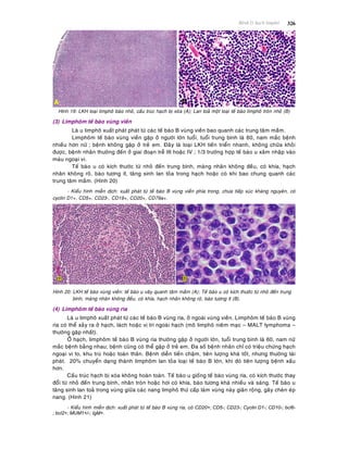 Beänh lyù haïch limphoâ 326
Hình 19: LKH loaïi limphoâ baøo nhoû, caáu truùc haïch bò xoùa (A); Lan toaû moät loaïi teá baøo limphoâ troøn nhoû (B)
(3) Limphoâm teá baøo vuøng vieàn
Laø u limphoâ xuaát phaùt phaùt töø caùc teá baøo B vuøng vieàn bao quanh caùc trung taâm maàm.
Limphoâm teá baøo vuøng vieàn gaëp ôû ngöôøi lôùn tuoåi, tuoåi trung bình laø 60, nam maéc beänh
nhieàu hôn nöõ ; beänh khoâng gaëp ôû treû em. Ñaây laø loaïi LKH tieán trieån nhanh, khoâng chöõa khoûi
ñöôïc, beänh nhaân thöôøng ñeán ôû giai ñoaïn treã III hoaëc IV ; 1/3 tröôøng hôïp teá baøo u xaâm nhaäp vaøo
maùu ngoaïi vi.
Teá baøo u coù kích thöôùc töø nhoû ñeán trung bình, maøng nhaân khoâng ñeàu, coù khía, haïch
nhaân khoâng roõ, baøo töông ít, taêng sinh lan toûa trong haïch hoaëc coù khi bao chung quanh caùc
trung taâm maàm. (Hình 20)
- Kieåu hình mieãn dòch: xuaát phaùt töø teá baøo B vuøng vieàn phía trong, chöa tieáp xuùc khaùng nguyeân, coù
cyclin D1+, CD5+, CD23-, CD19+, CD20+, CD79a+.
Hình 20: LKH teá baøo vuøng vieàn: teá baøo u vaây quanh taâm maàm (A); Teá baøo u coù kích thöôùc töø nhoû ñeán trung
bình, maøng nhaân khoâng ñeàu, coù khía, haïch nhaân khoâng roõ, baøo töông ít (B).
(4) Limphoâm teá baøo vuøng rìa
Laø u limphoâ xuaát phaùt töø caùc teá baøo B vuøng rìa, ôû ngoaøi vuøng vieàn. Limphoâm teá baøo B vuøng
rìa coù theå xaûy ra ôû haïch, laùch hoaëc vò trí ngoaøi haïch (moâ limphoâ nieâm maïc – MALT lymphoma –
thöôøng gaëp nhaát).
ÔÛ haïch, limphoâm teá baøo B vuøng rìa thöôøng gaëp ôû ngöôøi lôùn, tuoåi trung bình laø 60, nam nöõ
maéc beänh baèng nhau; beänh cuõng coù theå gaëp ôû treû em. Ña soá beänh nhaân chæ coù trieäu chöùng haïch
ngoaïi vi to, khu truù hoaëc toaøn thaân. Beänh dieãn tieán chaäm, tieân löôïng khaù toát, nhöng thöôøng taùi
phaùt. 20% chuyeån daïng thaønh limphoâm lan toûa loaïi teá baøo B lôùn, khi ñoù tieân löôïng beänh xaáu
hôn.
Caáu truùc haïch bò xoùa khoâng hoaøn toaøn. Teá baøo u gioáng teá baøo vuøng rìa, coù kích thöôùc thay
ñoåi töø nhoû ñeán trung bình, nhaân troøn hoaëc hôi coù khía, baøo töông khaù nhieàu vaø saùng. Teá baøo u
taêng sinh lan toaû trong vuøng giöõa caùc nang limphoâ thöù caáp laøm vuøng naøy giaõn roäng, gaây cheøn eùp
nang. (Hình 21)
- Kieåu hình mieãn dòch: xuaát phaùt töø teá baøo B vuøng rìa, coù CD20+; CD5-; CD23-; Cyclin D1-; CD10-; bcl6-
; bcl2+; MUM1+/-; IgM+.
 