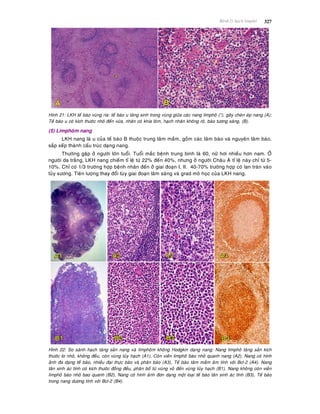 Beänh lyù haïch limphoâ 327
Hình 21: LKH teá baøo vuøng rìa: teá baøo u taêng sinh trong vuøng giöõa caùc nang limphoâ (*), gaây cheøn eùp nang (A);
Teá baøo u coù kích thöôùc nhoû ñeán vöøa, nhaân coù khía loõm, haïch nhaân khoâng roõ, baøo töông saùng, (B).
(5) Limphoâm nang
LKH nang laø u cuûa teá baøo B thuoäc trung taâm maàm, goàm caùc taâm baøo vaø nguyeân taâm baøo,
saép xeáp thaønh caáu truùc daïng nang.
Thöôøng gaëp ôû ngöôøi lôùn tuoåi. Tuoåi maéc beänh trung bình laø 60, nöõ hôi nhieàu hôn nam. ÔÛ
ngöôøi da traéng, LKH nang chieám tæ leä töø 22% ñeán 40%, nhöng ôû ngöôøi Chaâu AÙ tæ leä naøy chæ töø 5-
10%. Chæ coù 1/3 tröôøng hôïp beänh nhaân ñeán ôû giai ñoaïn I, II. 40-70% tröôøng hôïp coù lan traøn vaøo
tuûy xöông. Tieân löôïng thay ñoåi tuøy giai ñoaïn laâm saøng vaø grad moâ hoïc cuûa LKH nang.
Hình 22: So saùnh haïch taêng saûn nang vaø limphoâm khoâng Hodgkin daïng nang: Nang limphoâ taêng saûn kích
thöôùc to nhoû, khoâng ñeàu, coøn vuøng tuûy haïch (A1), Coøn vieàn limphoâ baøo nhoû quanh nang (A2), Nang coù hình
aûnh ña daïng teá baøo, nhieàu ñaïi thöïc baøo vaø phaân baøo (A3), Teá baøo taâm maàm aâm tính vôùi Bcl-2 (A4). Nang
taân sinh aùc tính coù kích thöôùc ñoàng ñeàu, phaân boá töø vuøng voû ñeán vuøng tuûy haïch (B1), Nang khoâng coøn vieàn
limphoâ baøo nhoû bao quanh (B2), Nang coù hình aûnh ñôn daïng moät loaïi teá baøo taân sinh aùc tính (B3), Teá baøo
trong nang döông tính vôùi Bcl-2 (B4).
 